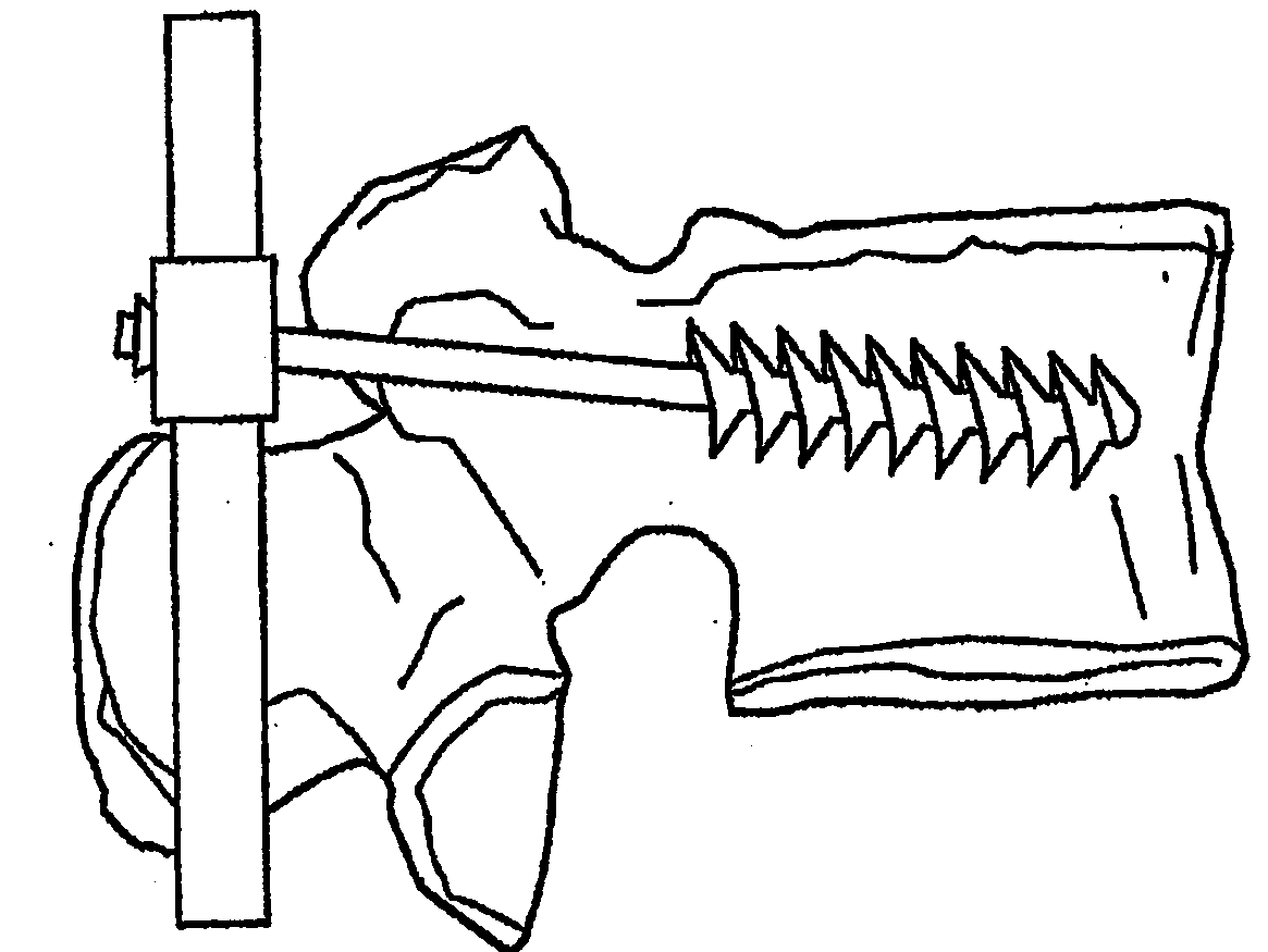 System and method for the fixation of bone fractures