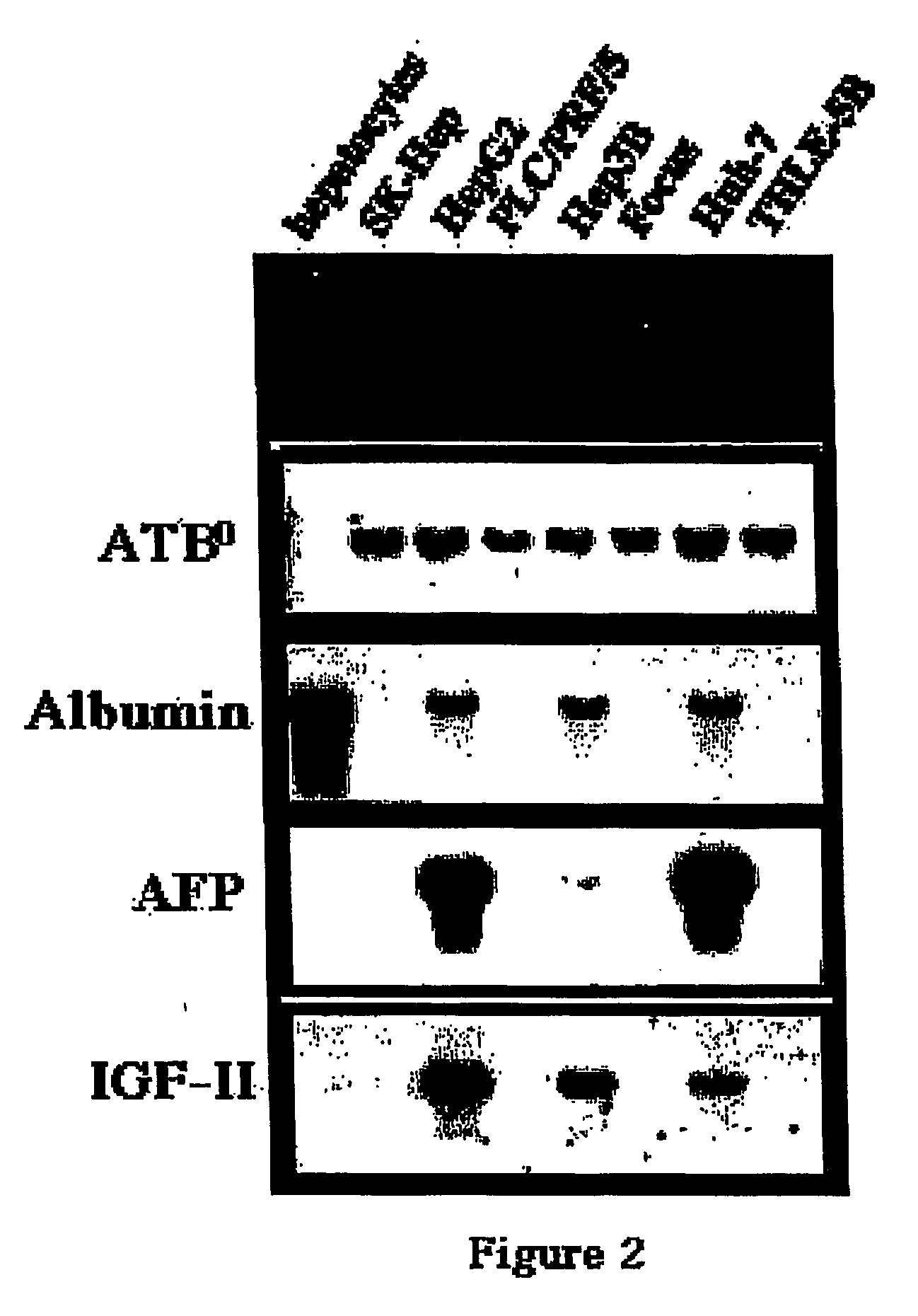 Compositions and methods of treating and diagnosing hepatoma