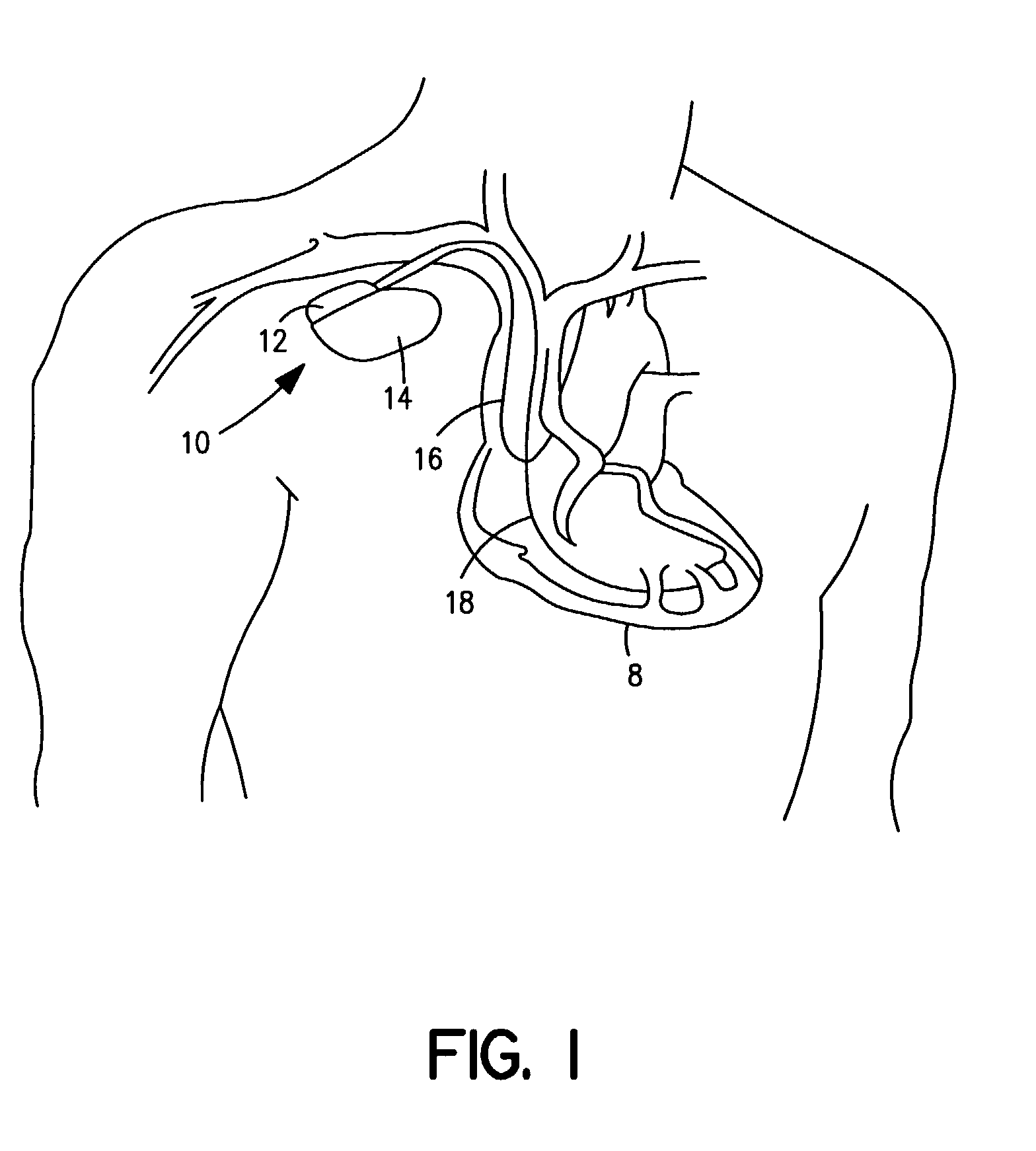 Method and system for compressing and storing data in a medical device having limited storage