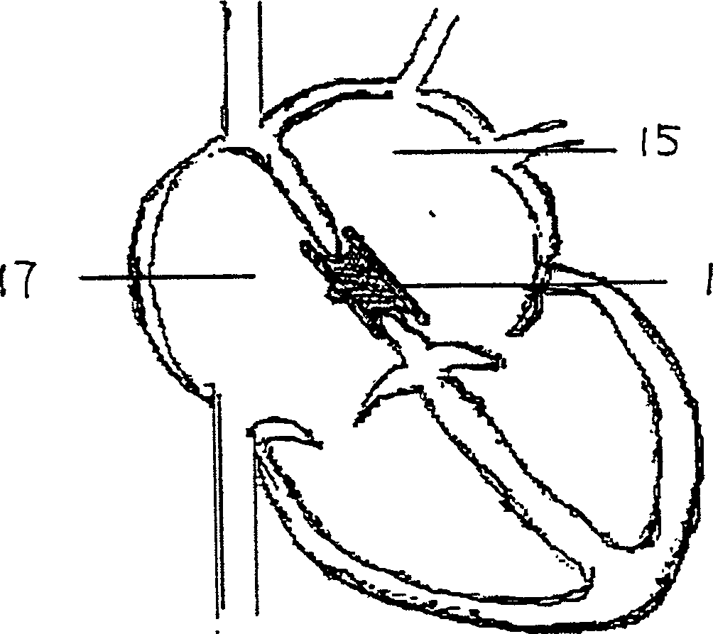 Stopper for congenital heart structural defect, its manufacturing method