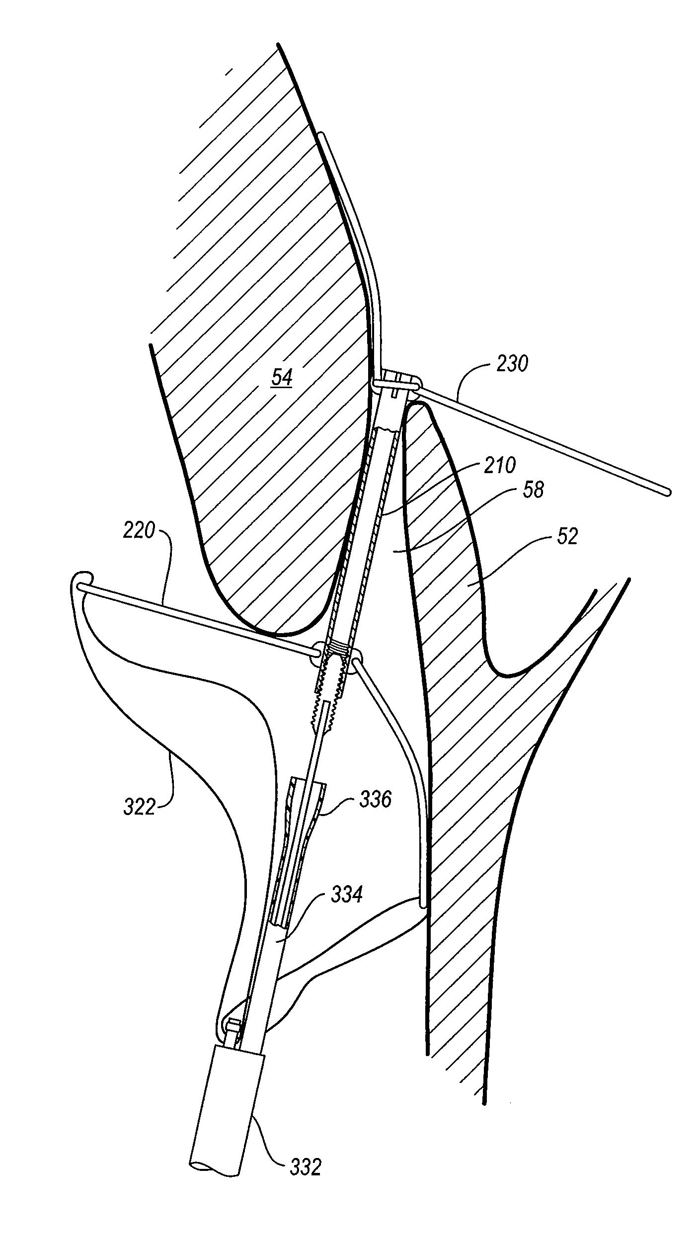 Delivery system for patent foramen ovale closure device