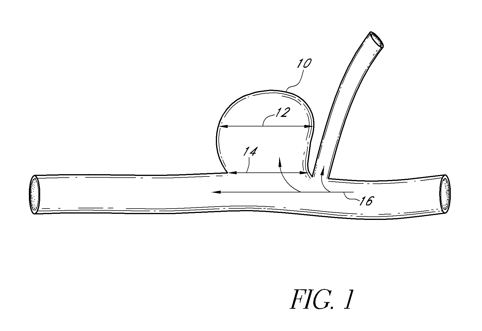 Vascular remodeling device