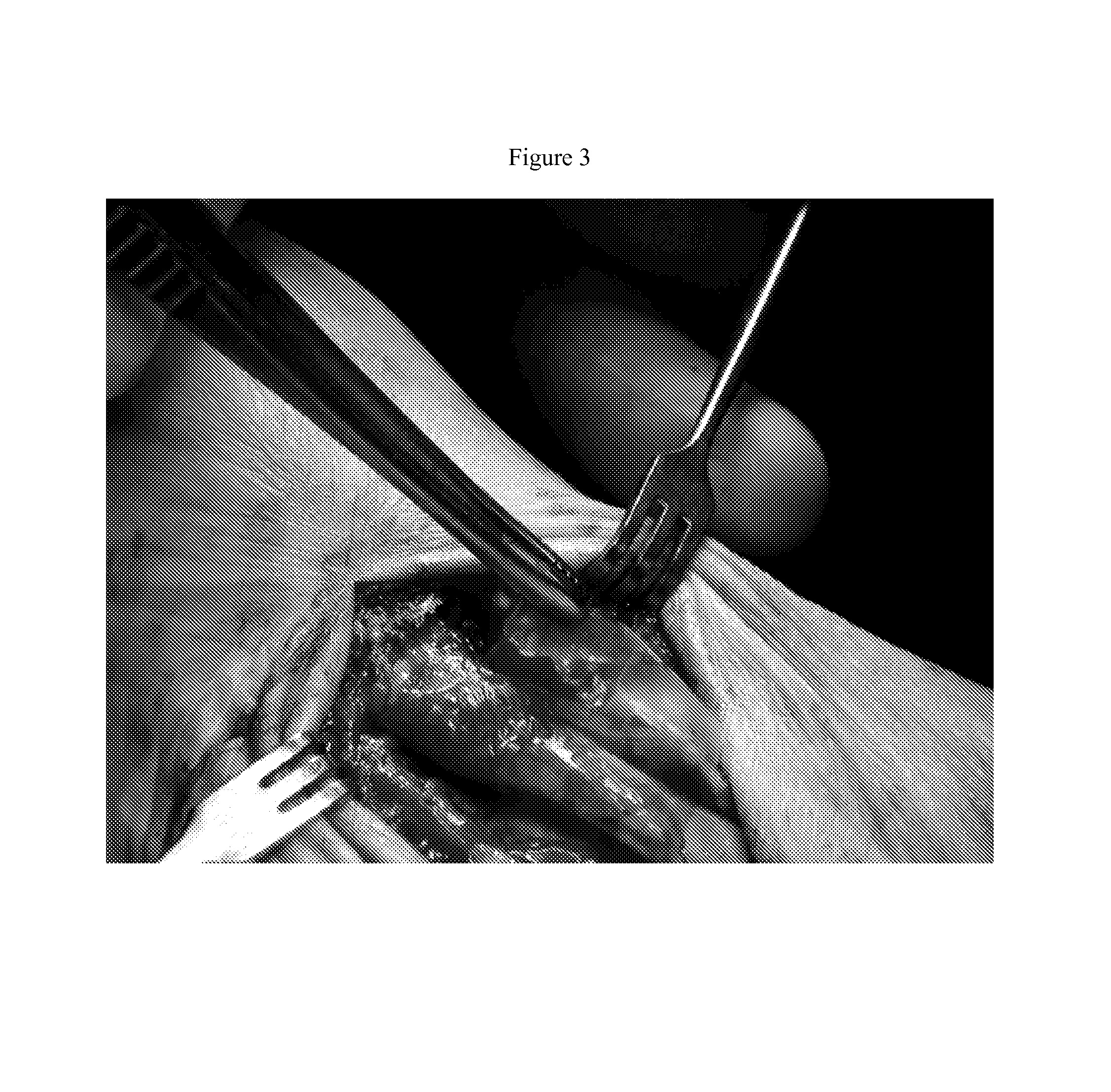 Method of tendon repair with amnion and chorion constructs