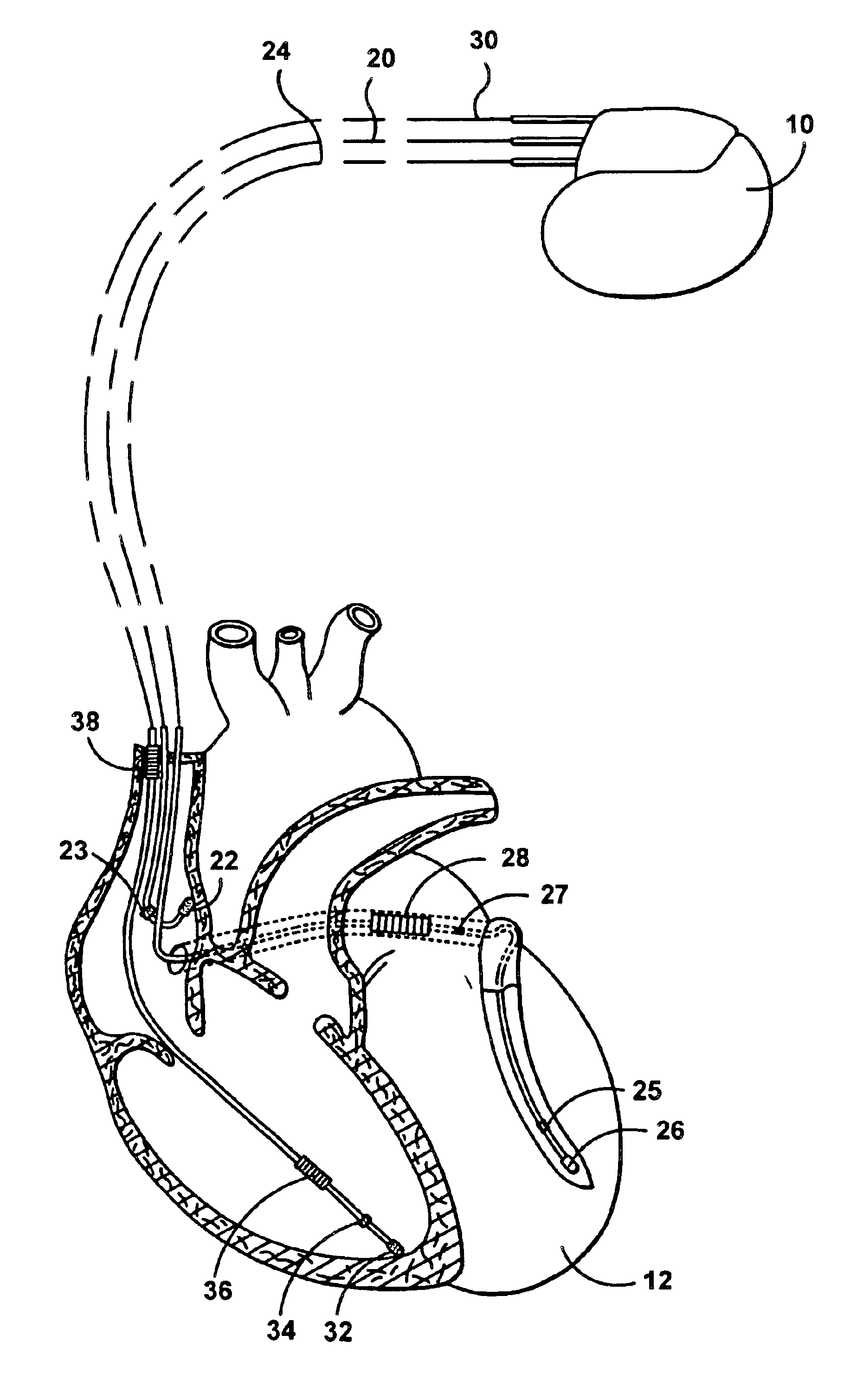 Apparatus and method for automatically sensing threshold histogram with differentiation of sinus from ectopic beats