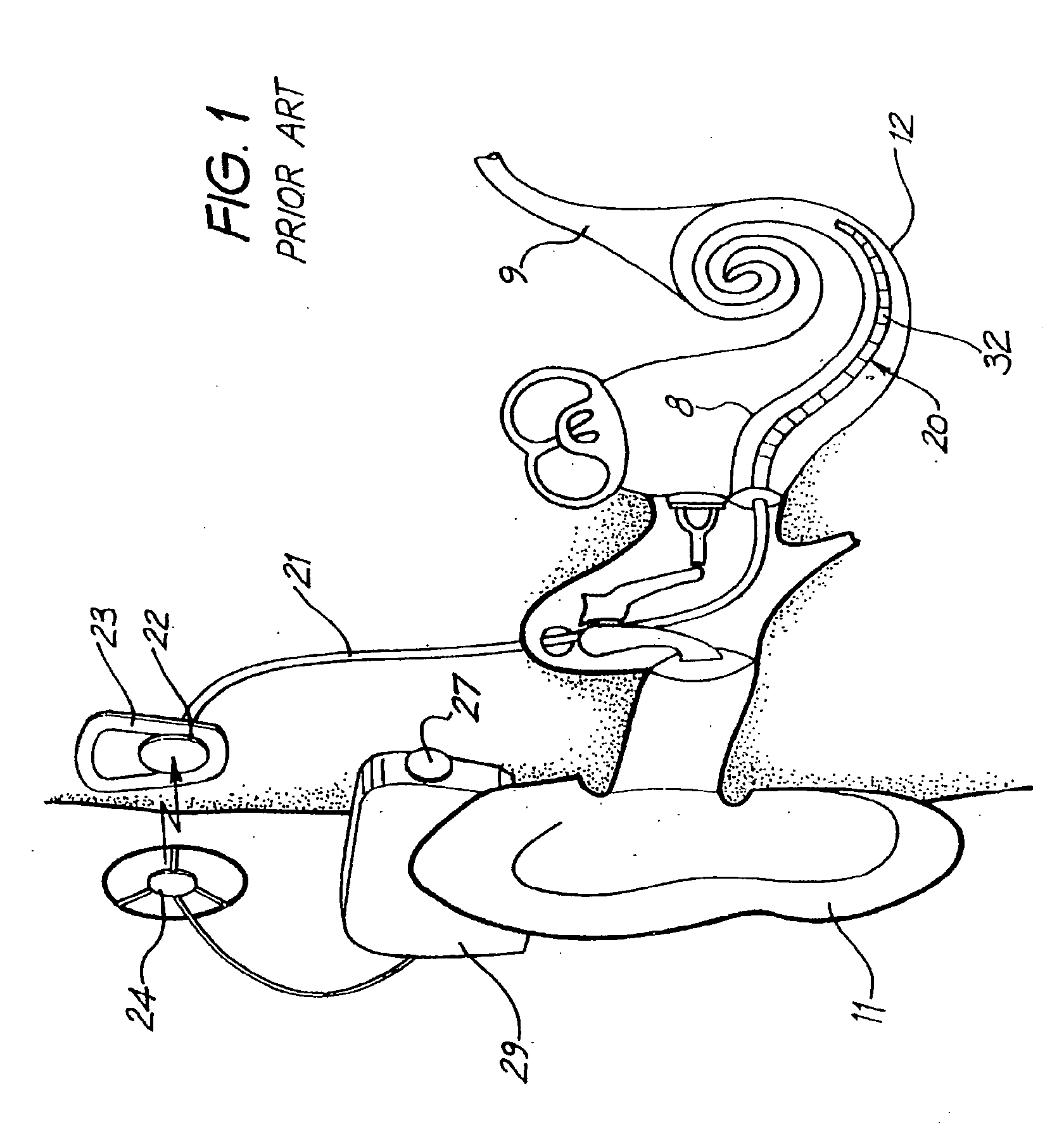 Cochlear implant drug delivery device