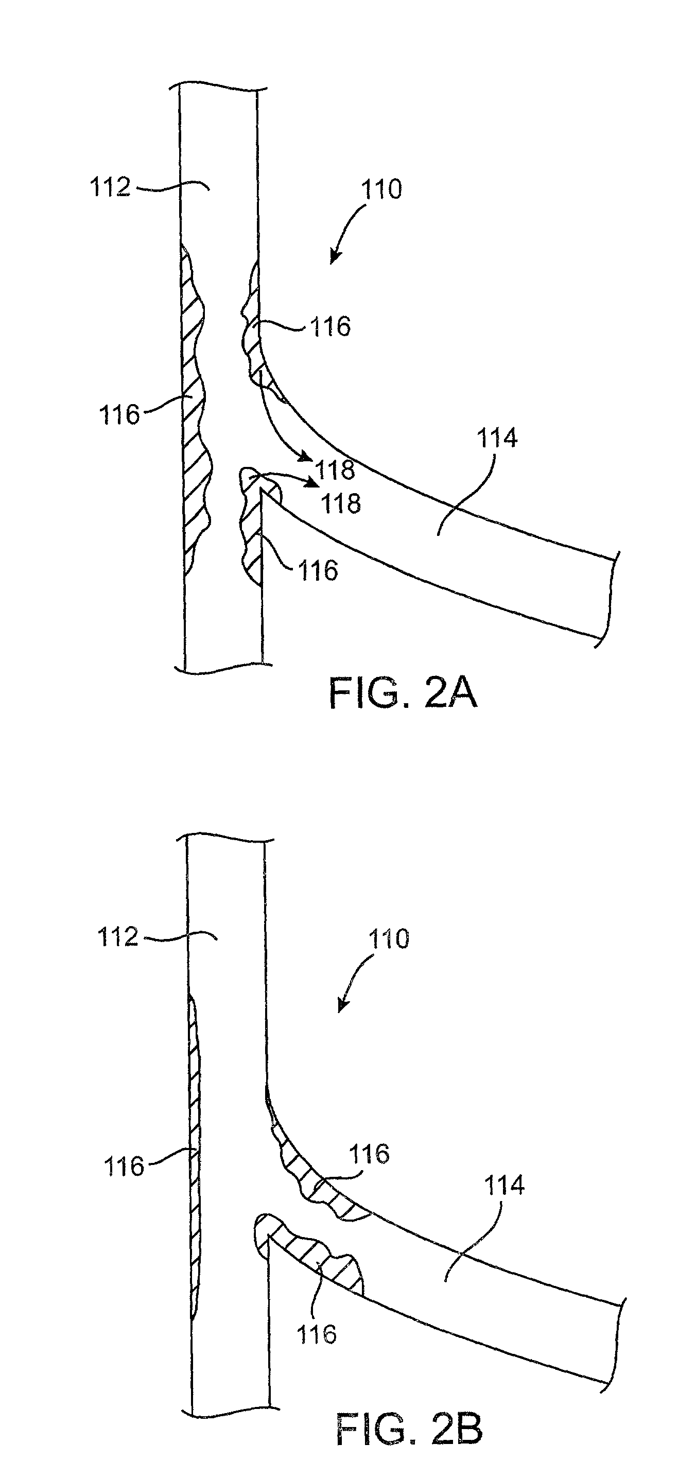 Cryotherapy methods for treating vessel dissections and side branch occlusion