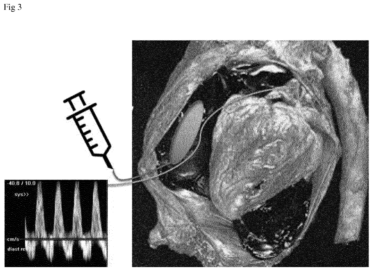 Device and Method for Diagnosis of Cardiac Tamponade