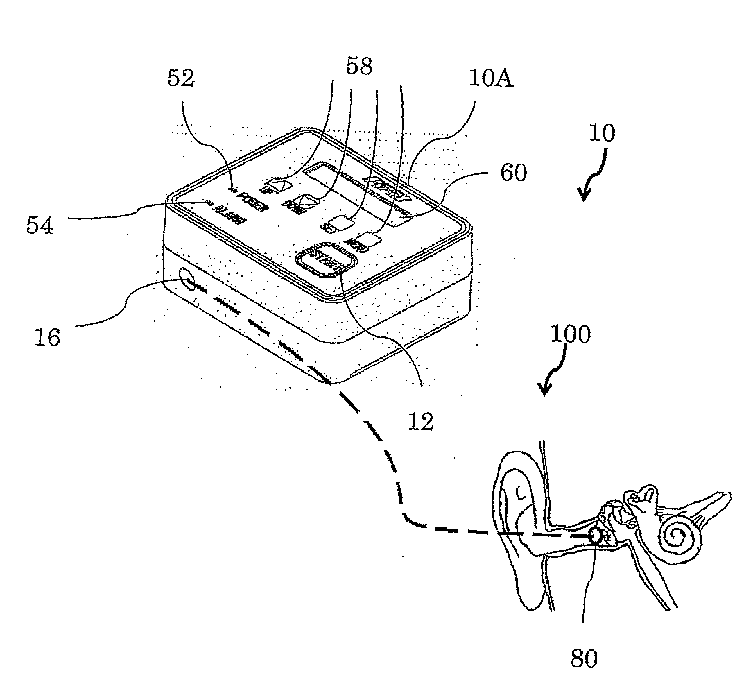 A portable device for treating meniere's disease and similar conditions