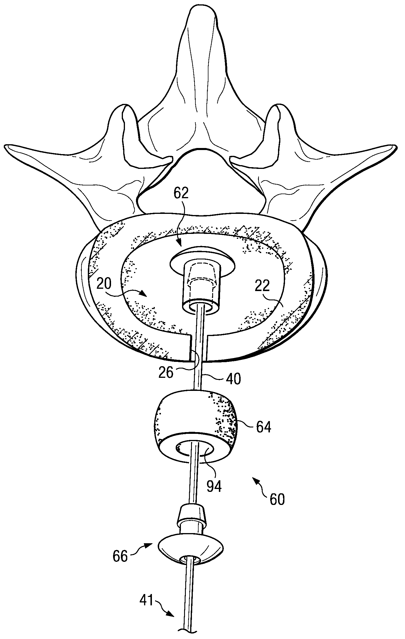 Spinal nucleus replacement implants