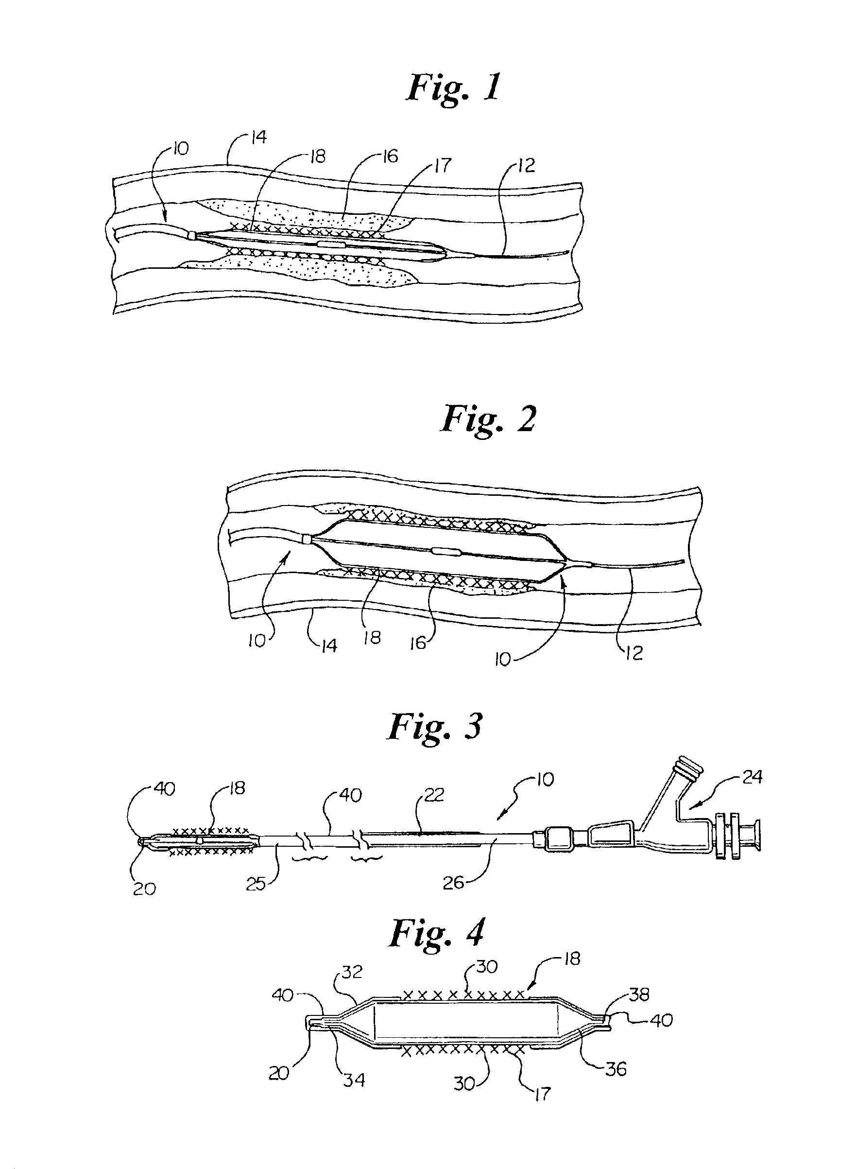 Selective coating of a balloon catheter with lubricious material for stent deployment