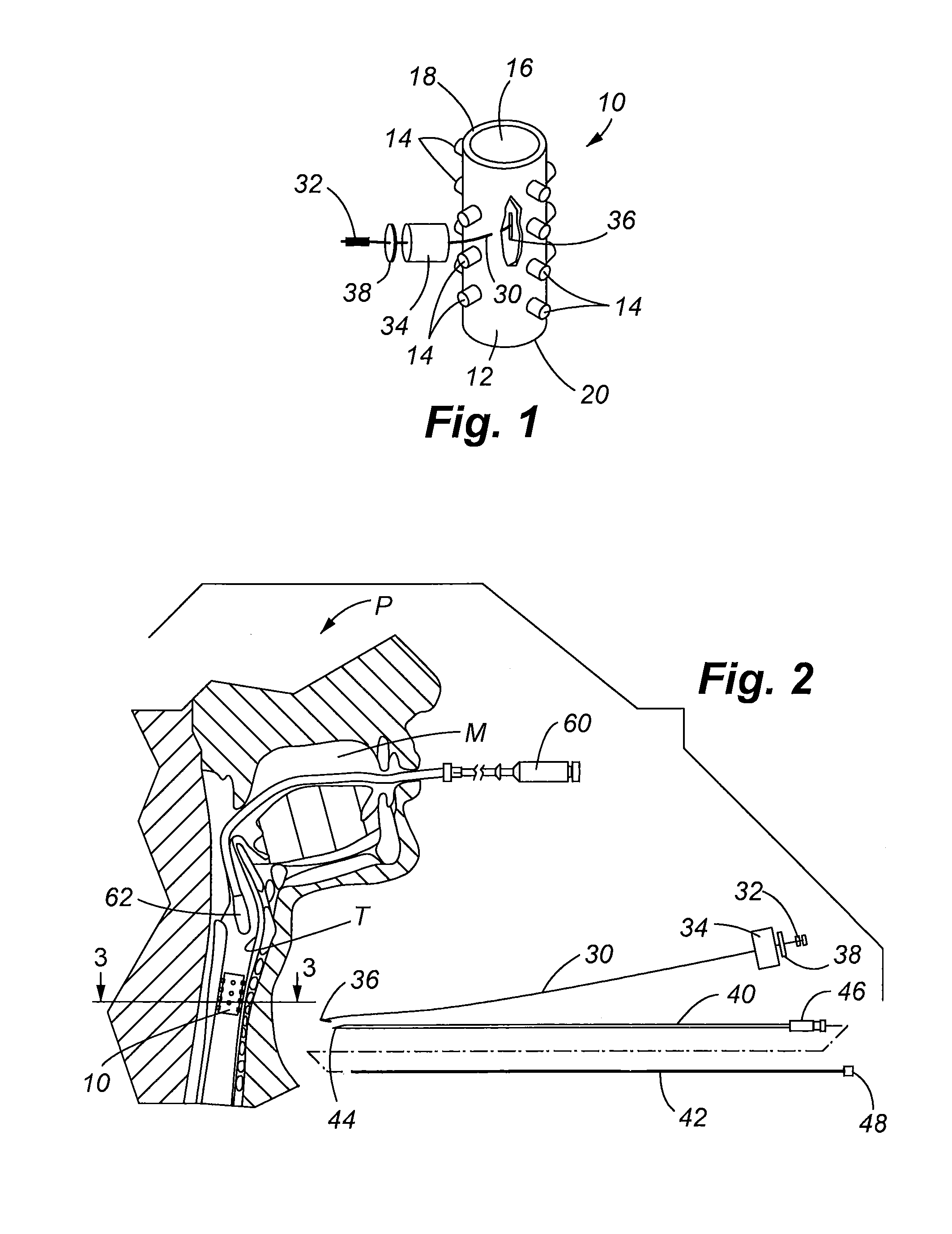 Airway anchor suture to prevent airway stent migration