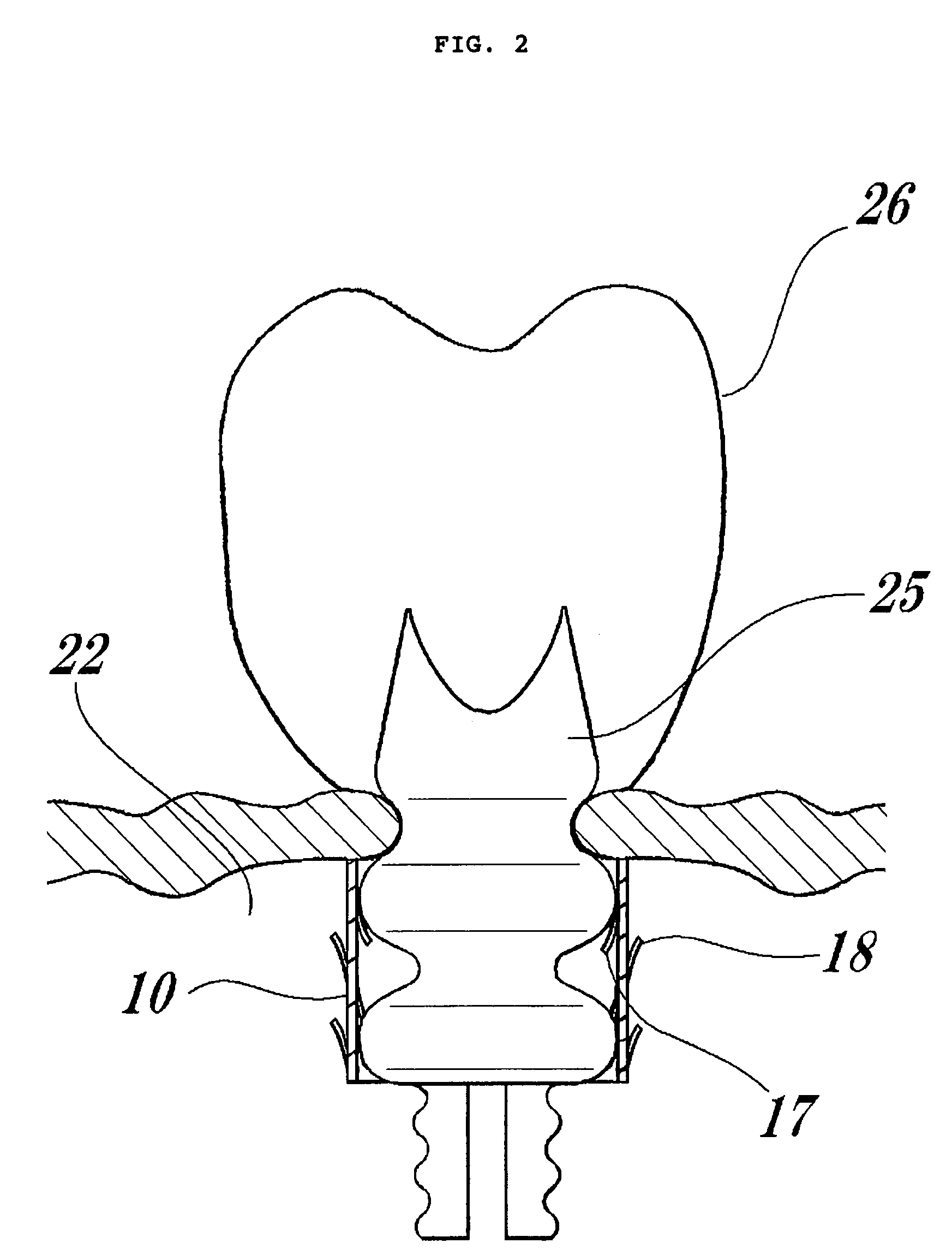 Artificial socket bone