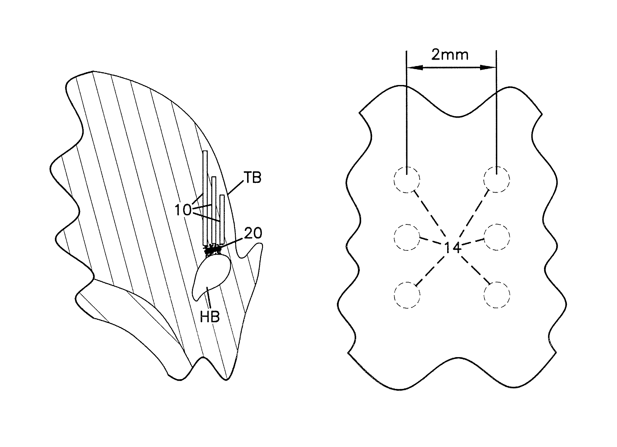 Stiffening procedure for sleep apnea