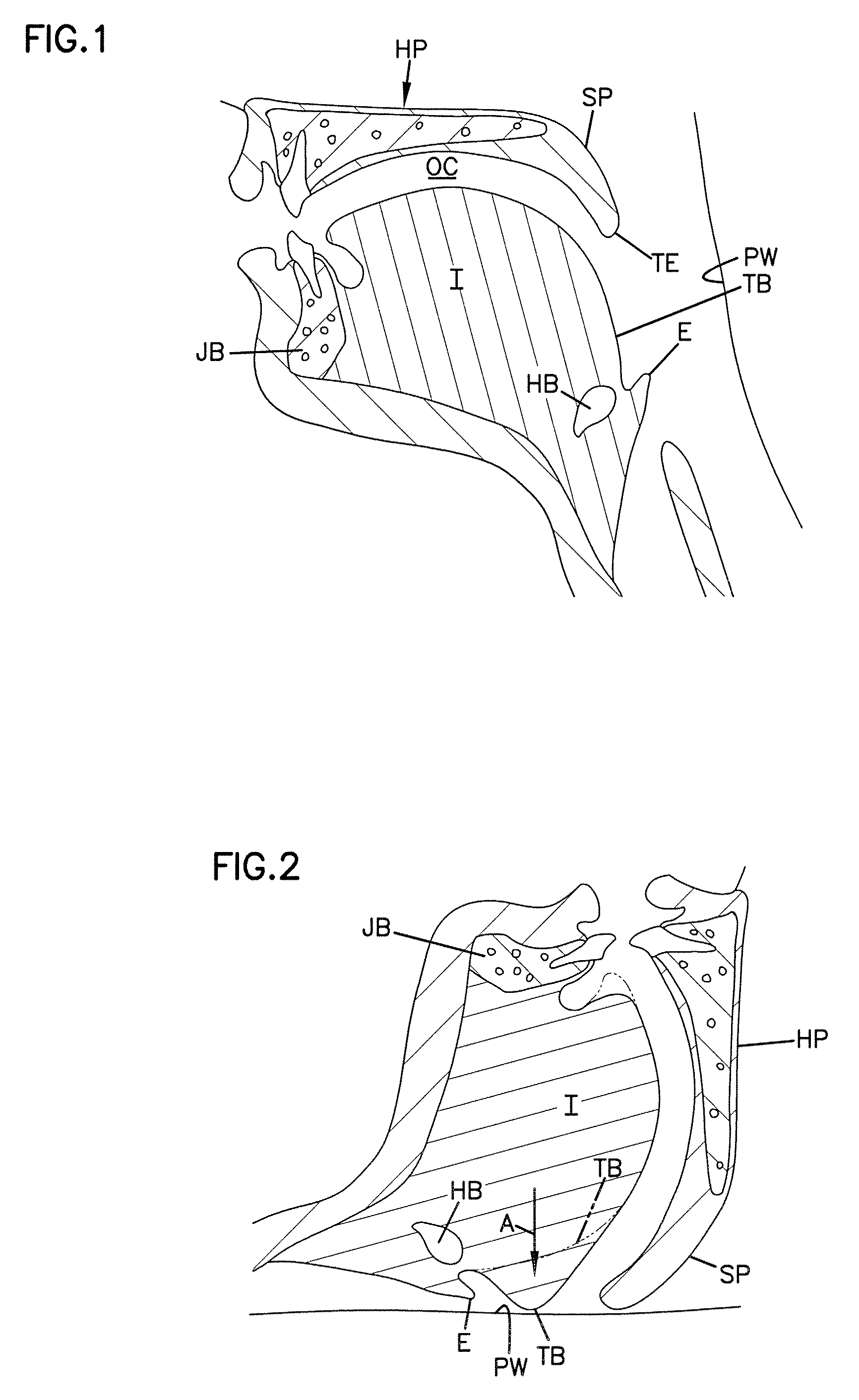 Stiffening procedure for sleep apnea