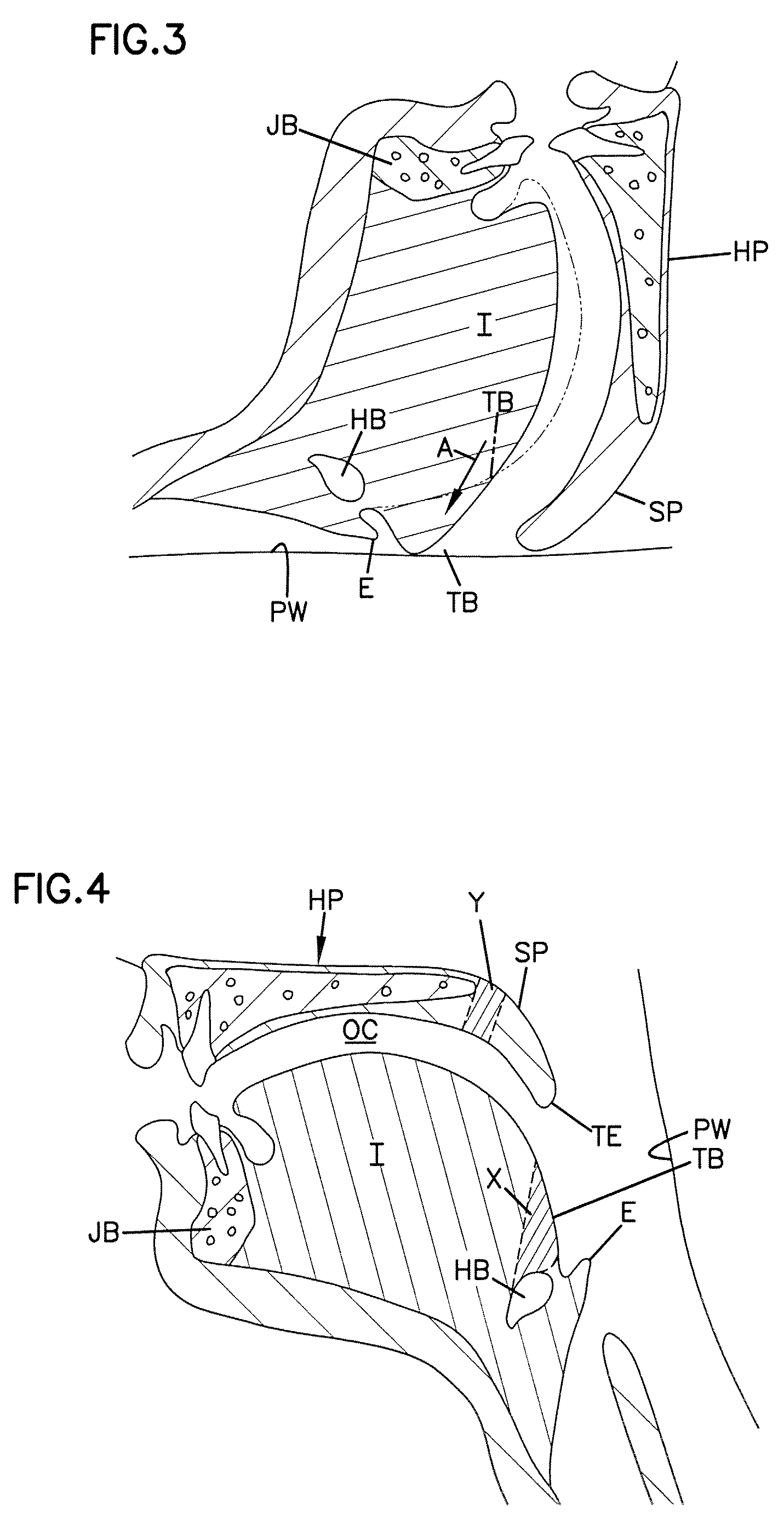 Stiffening procedure for sleep apnea