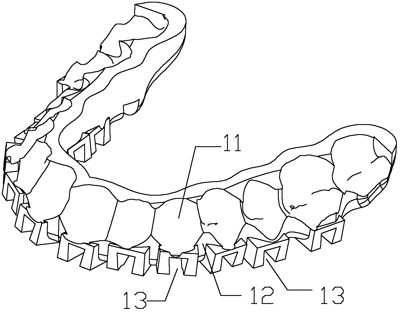 Digitalized guiding template for orthodontic bracket indirect bonding