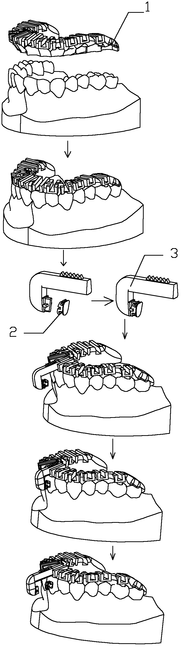 Digitalized guiding template for orthodontic bracket indirect bonding