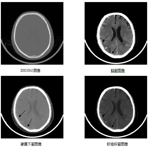 Intracranial hemorrhage detection model with optimized and enhanced window adjustment and construction method of intracranial hemorrhage detection model