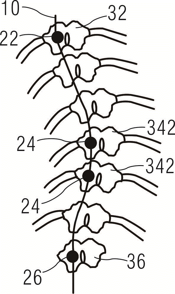 Internally fixed orthotics of growing-stage scoliosis