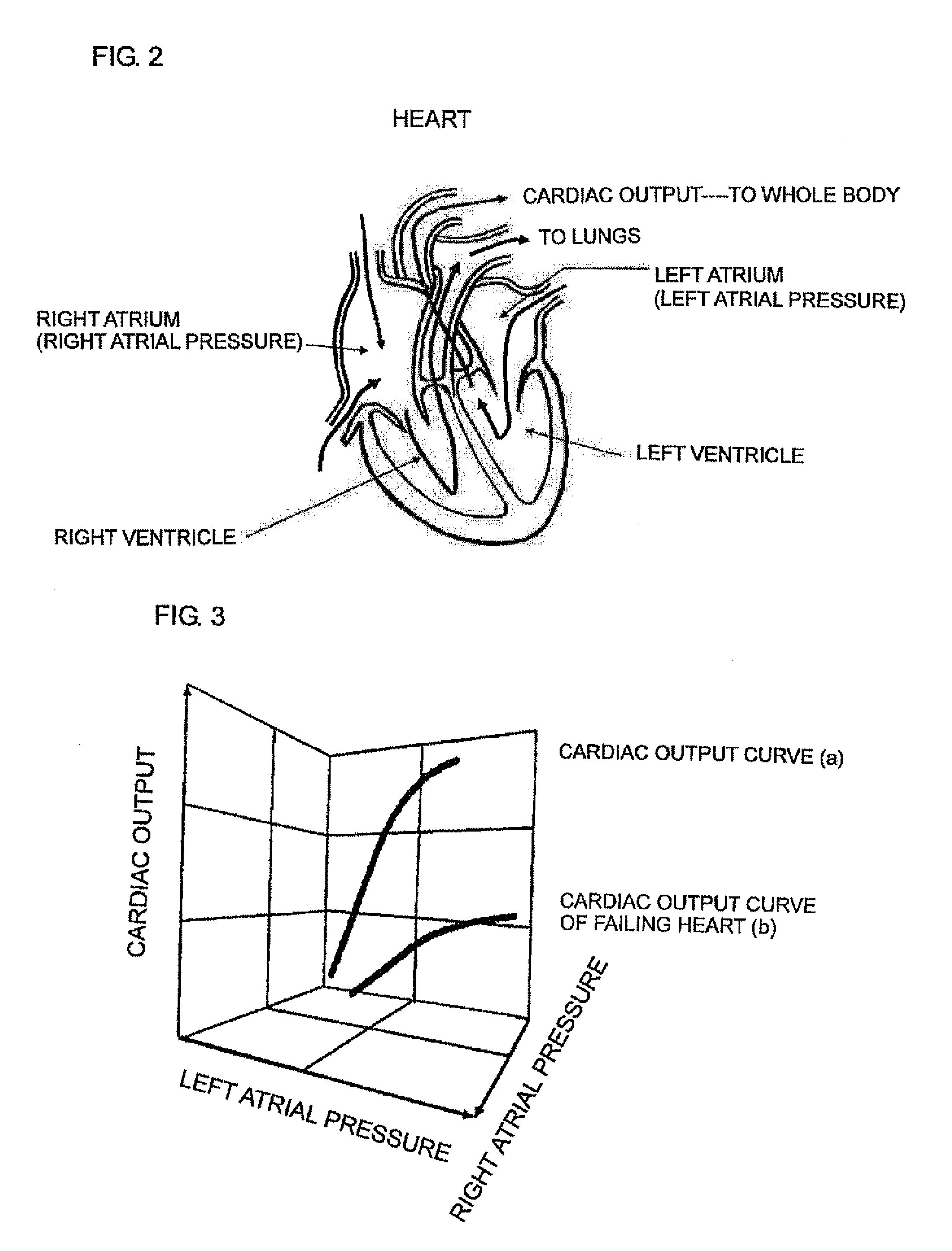 Cardiac Disease Treatment System