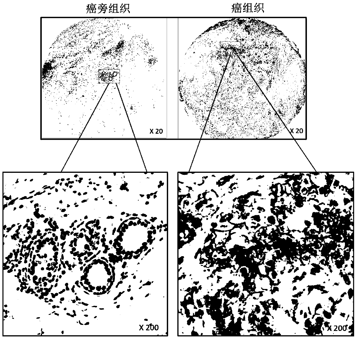 Application of ICOSL protein in preparation of kit used for breast cancer prognosis evaluation