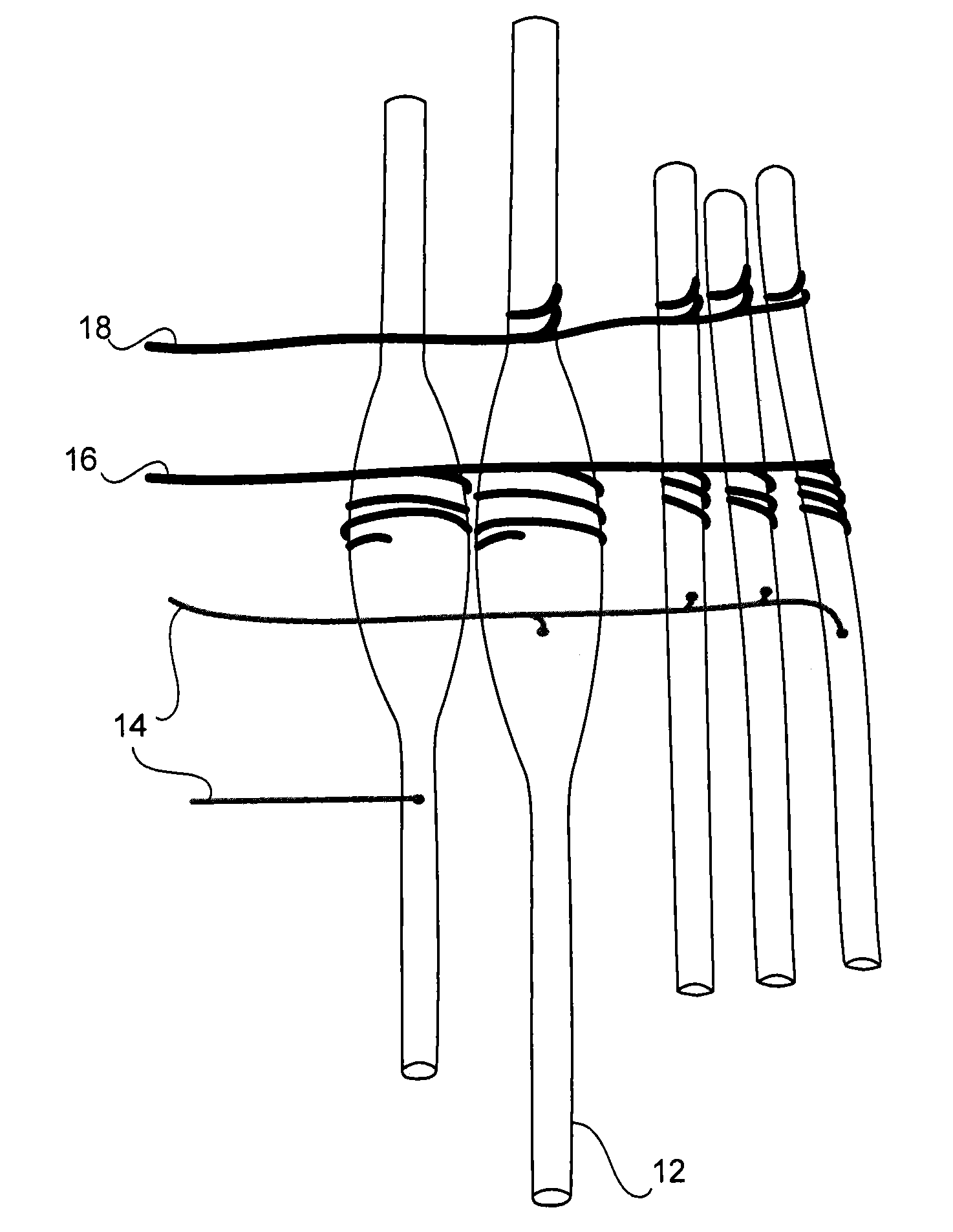 Method and apparatus for the treatment of focal dystonia