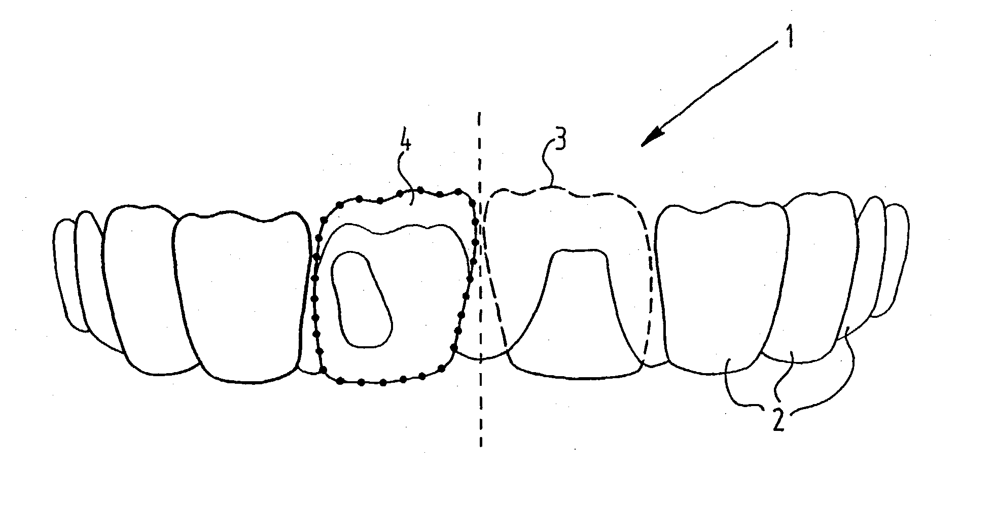 Method for production of an artificial tooth