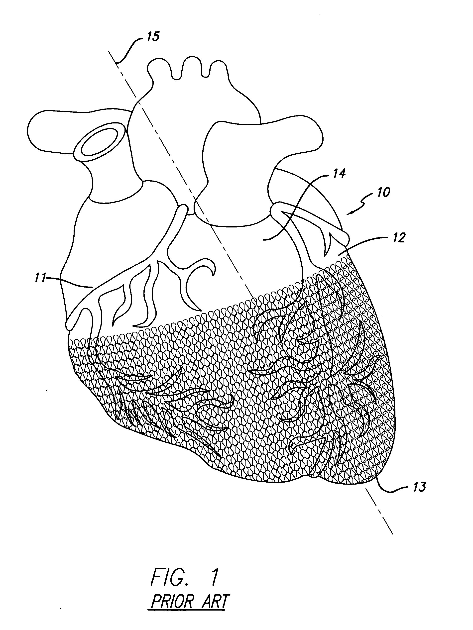 Cardiac harness for treating heart disease