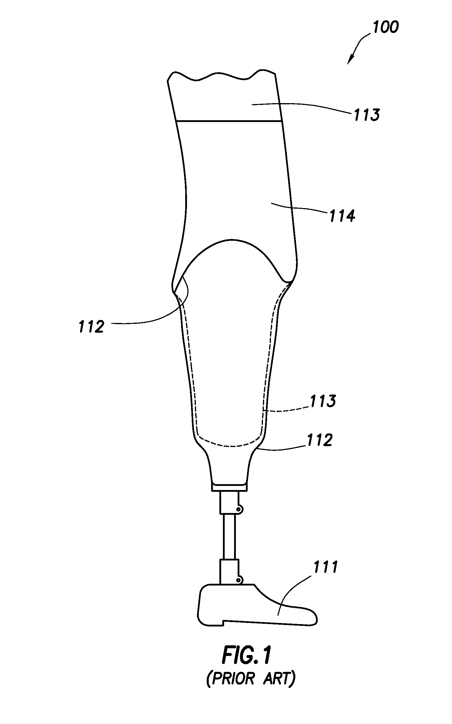 Intelligent prosthetic socket system with active user feedback interface and real time prosthesis diagnostics