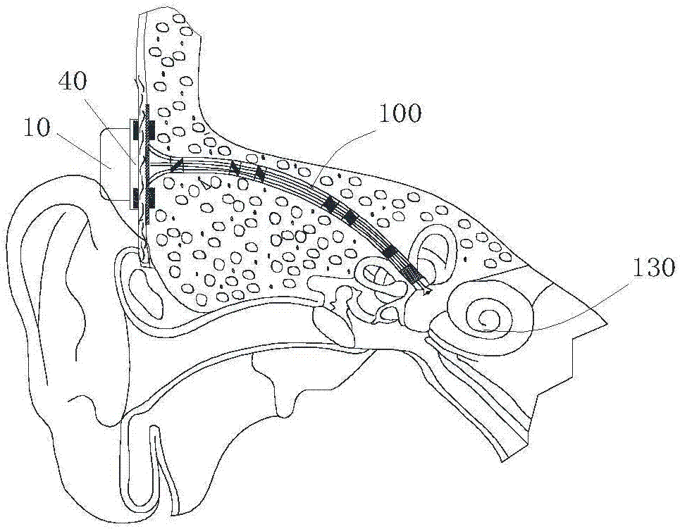 Bone conduction hearing aid device