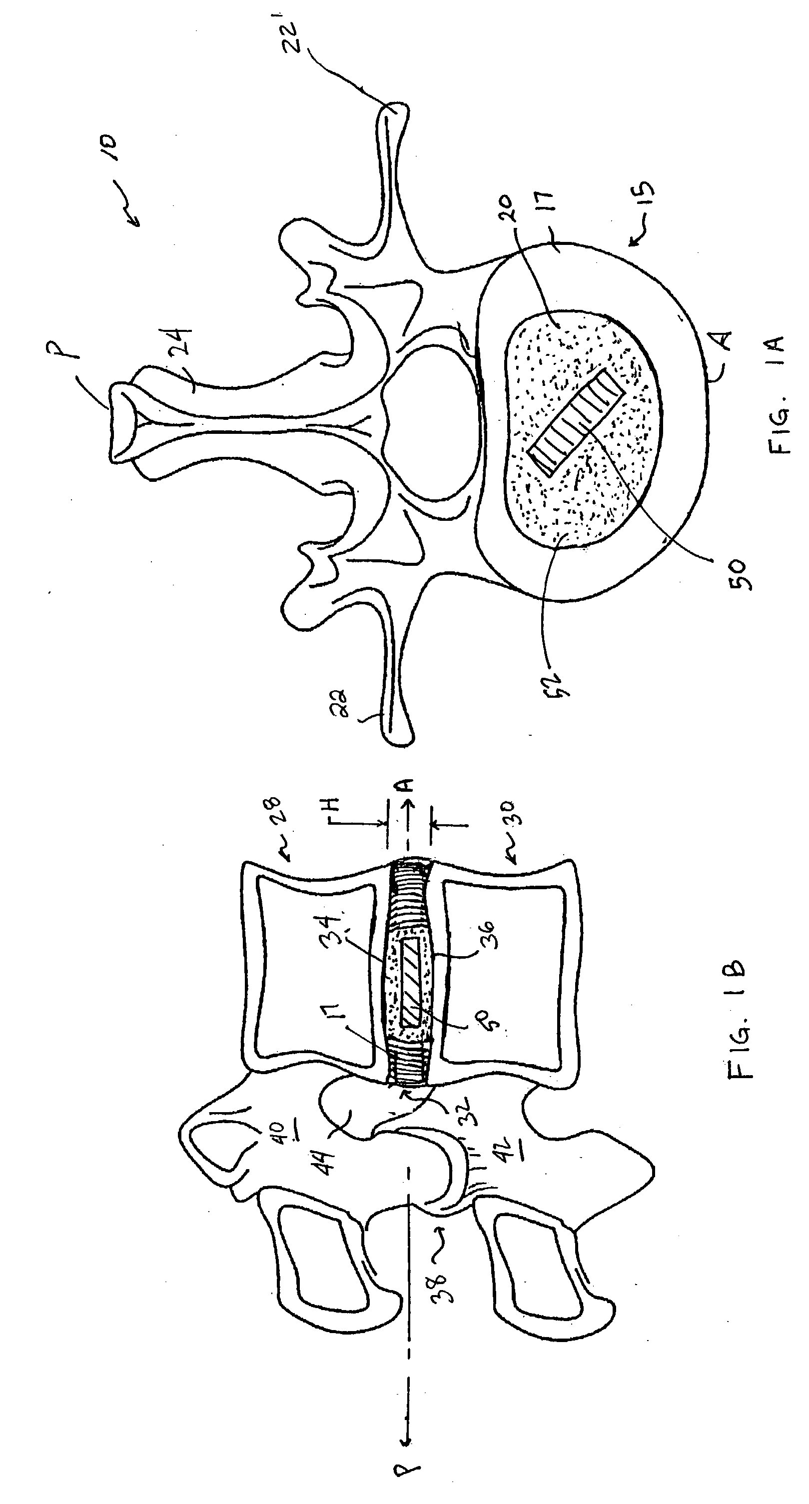 Devices and method for augmenting a vertebral disc