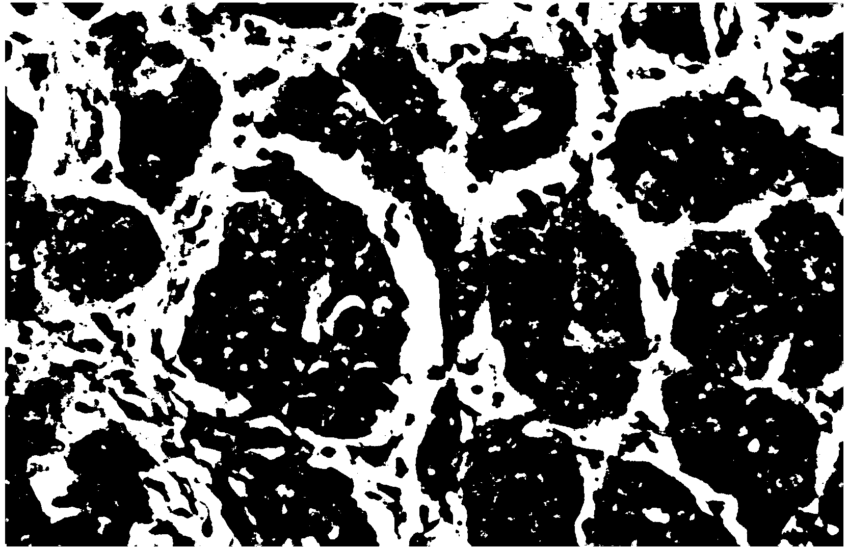 Application of galectin-4 protein in preparation of huge liver cancer postoperative prognostic evaluation kit