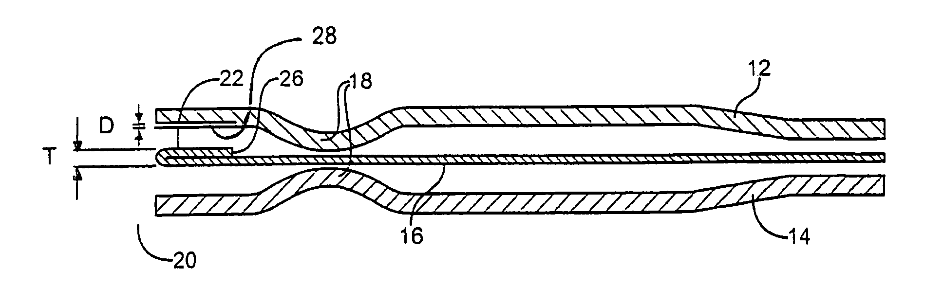 Enhanced multilayer metal gasket