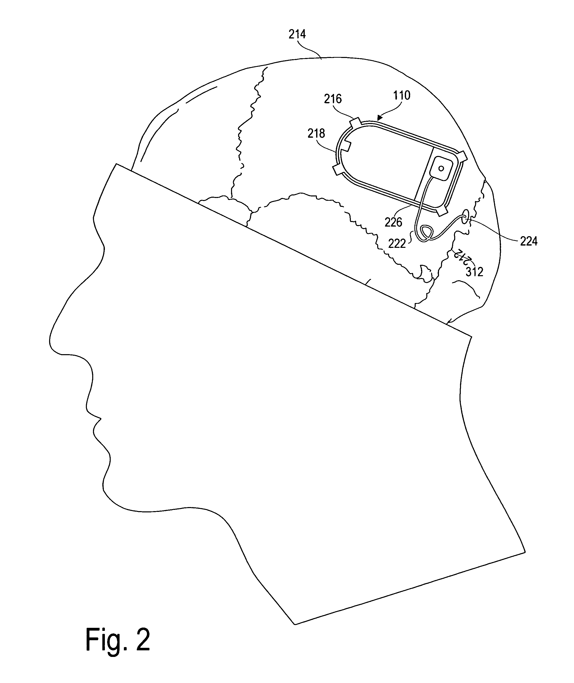 Implantable system enabling responsive therapy for pain