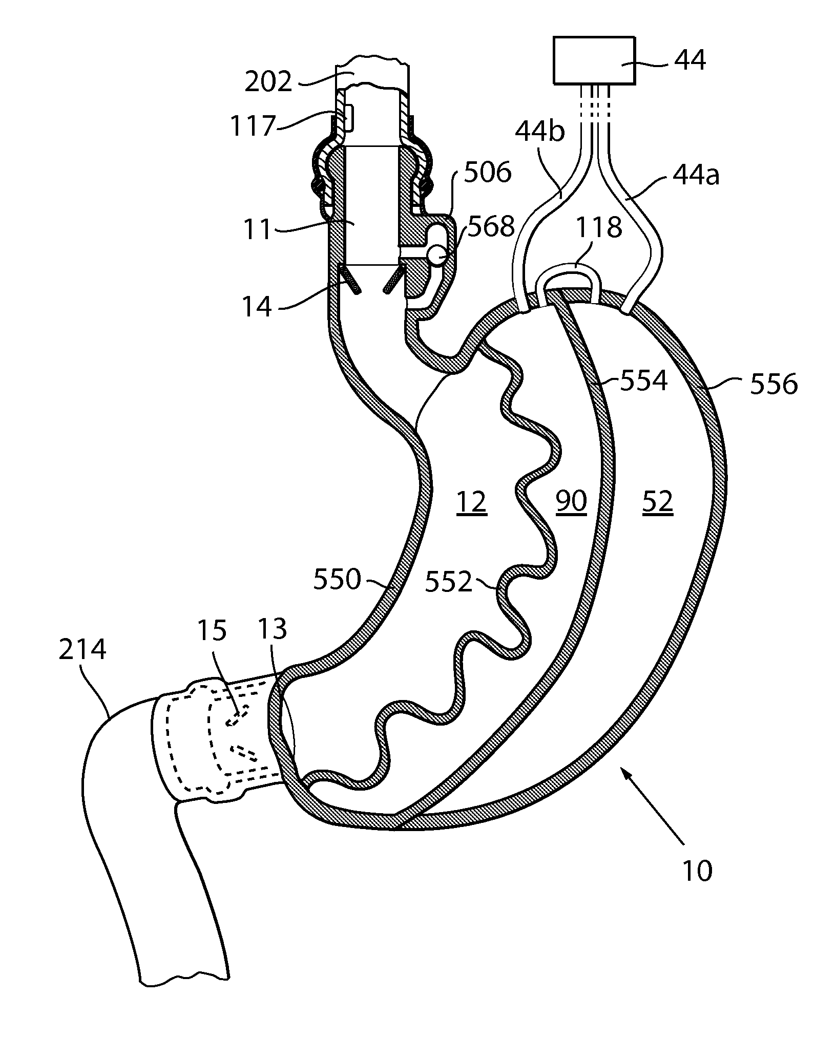 Artificial stomach