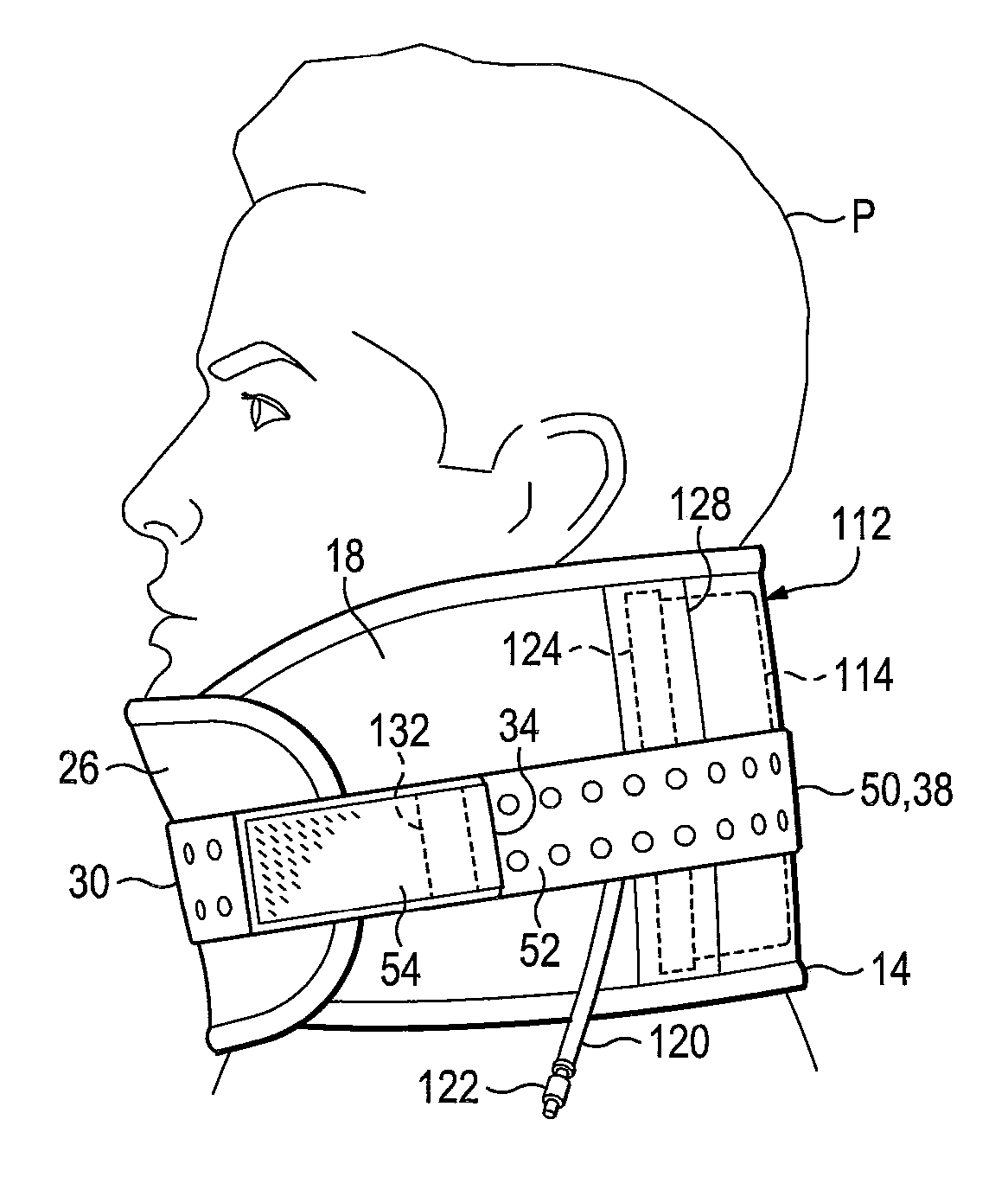 Emergency stabilization of a fractured pelvis or an injured neck