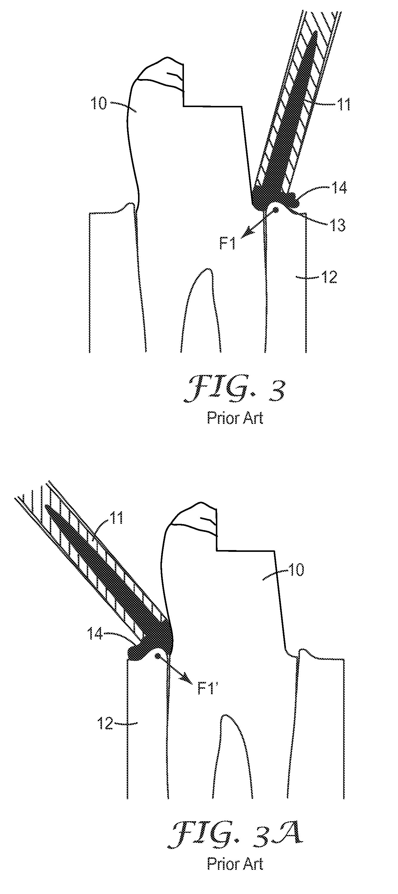 Device and a method for delivery of a dental composition