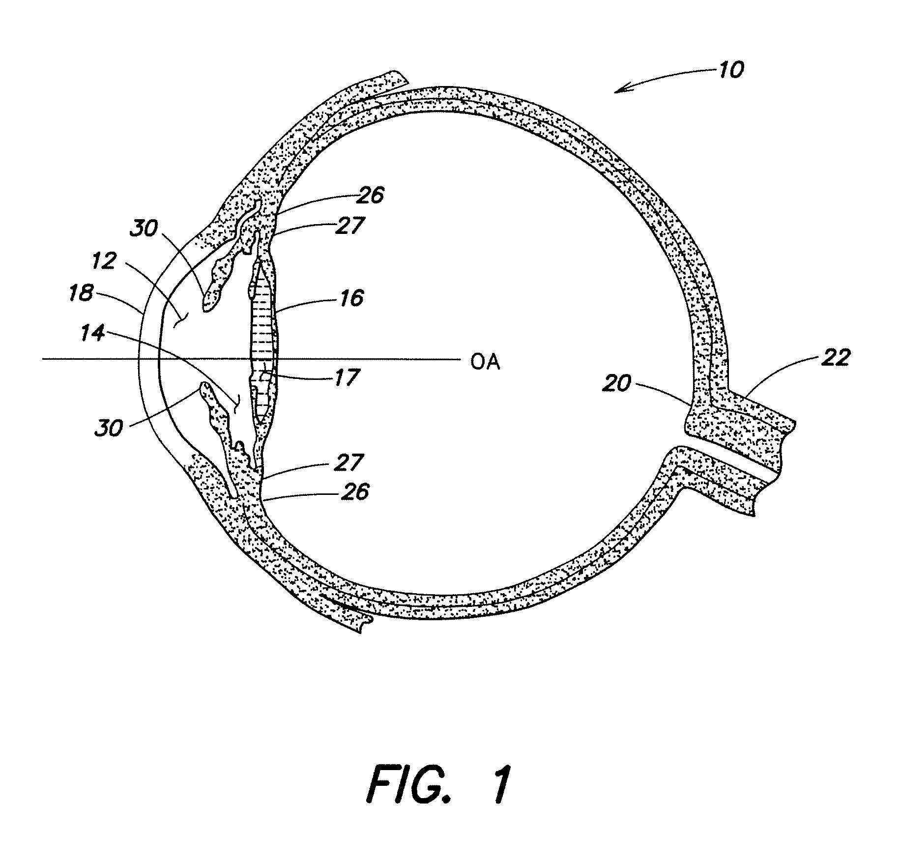 Accommodative Intraocular Lens