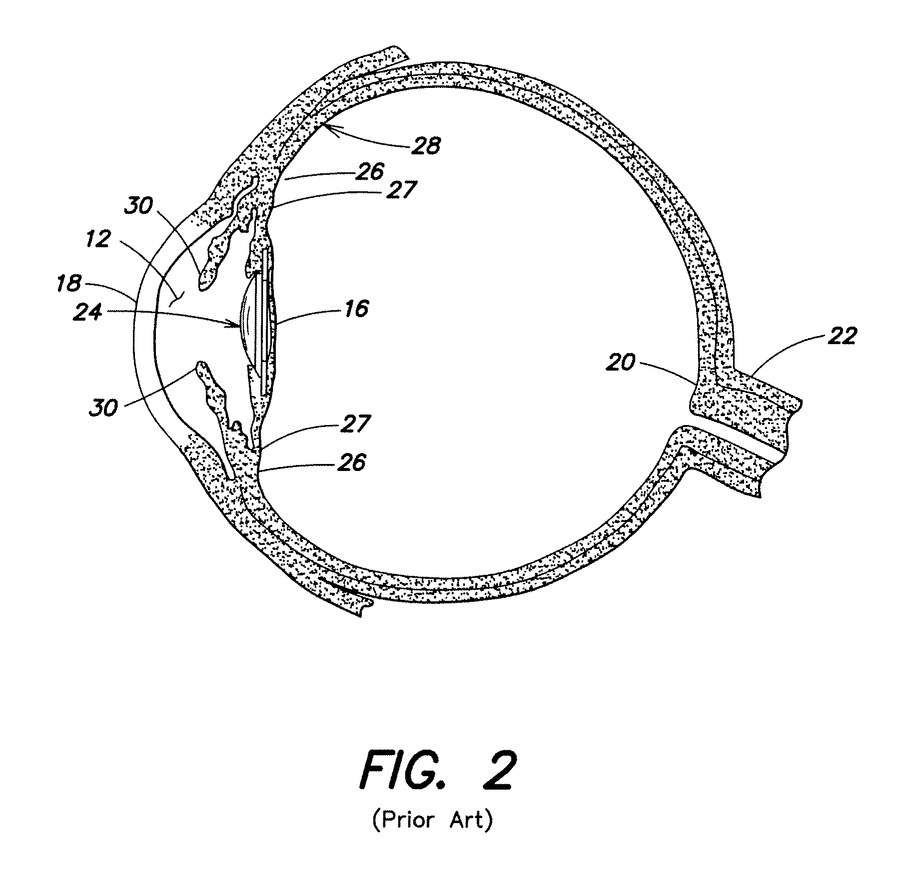 Accommodative Intraocular Lens