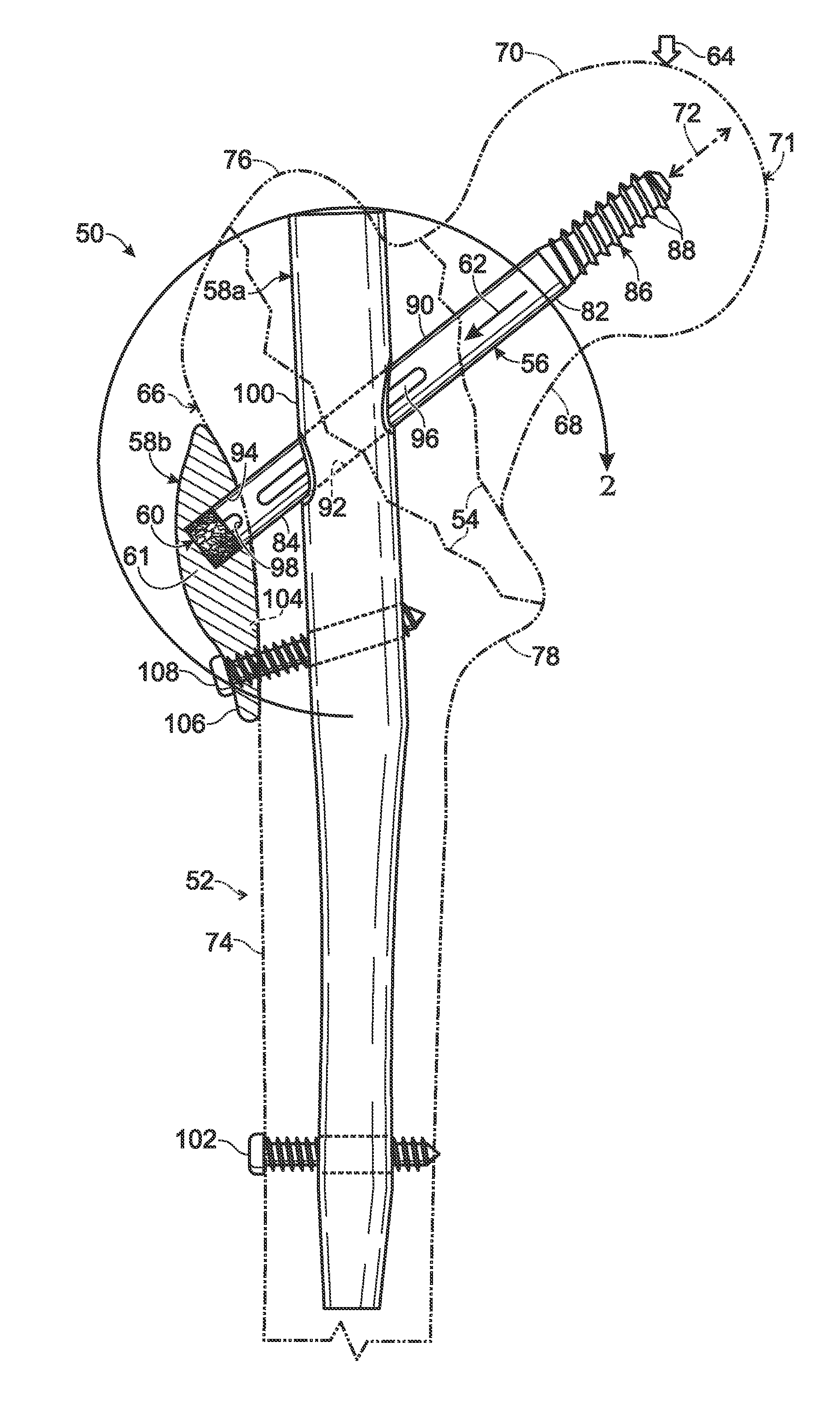 Hip fixation with load-controlled dynamization