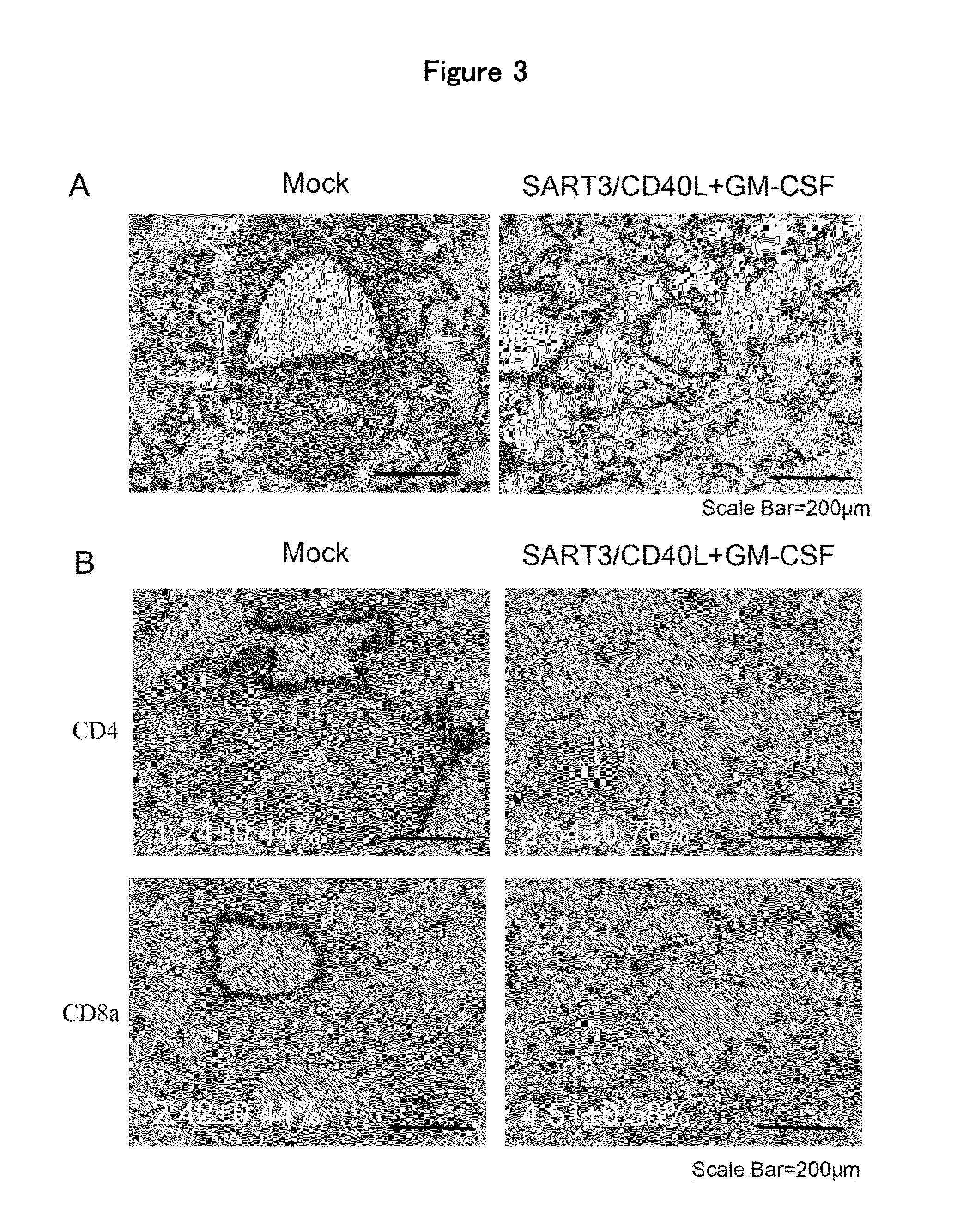 Anti-tumor DNA vaccine