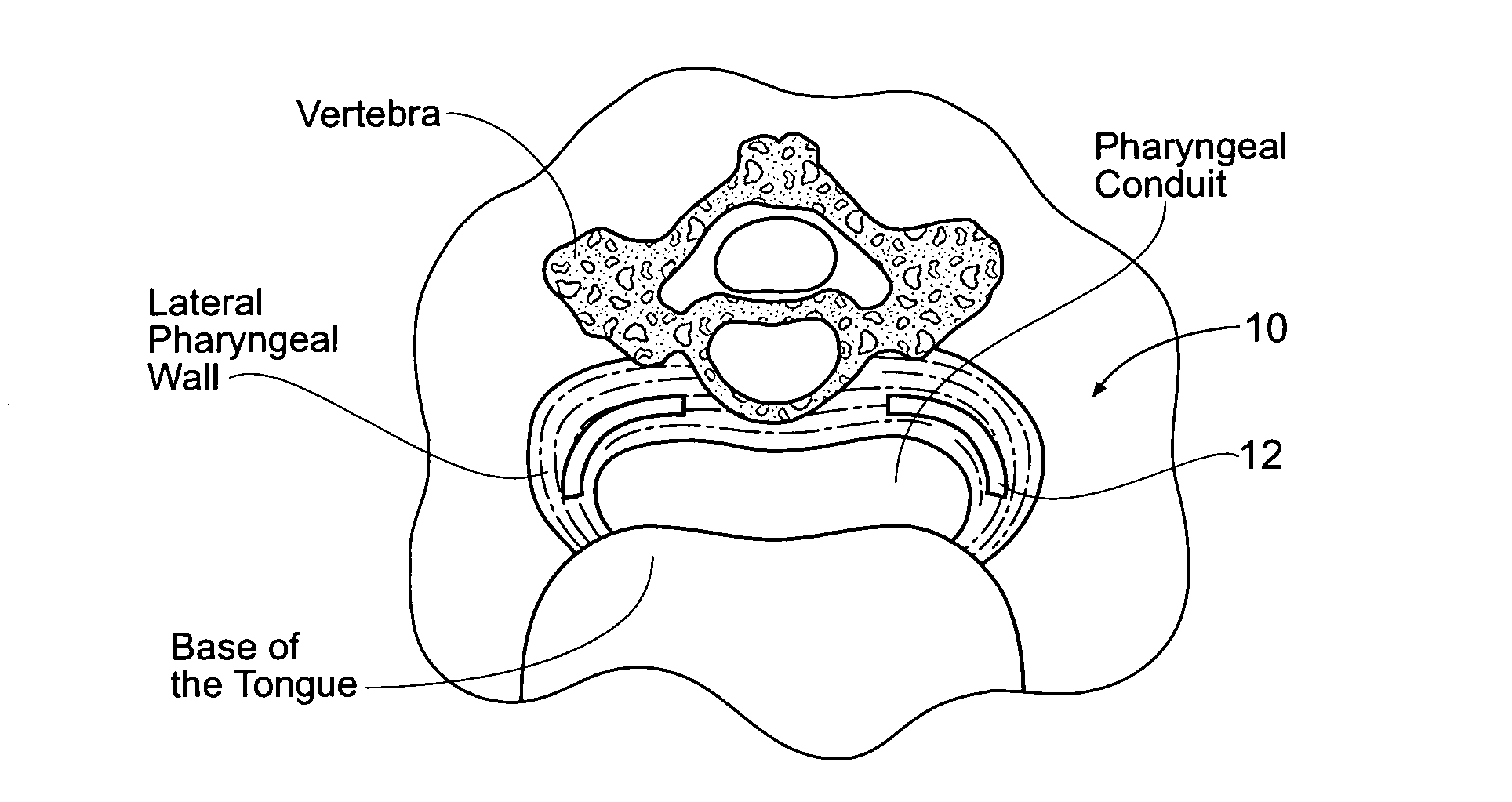 Devices, systems, and methods to fixate tissue within the regions of body, such as the pharyngeal conduit