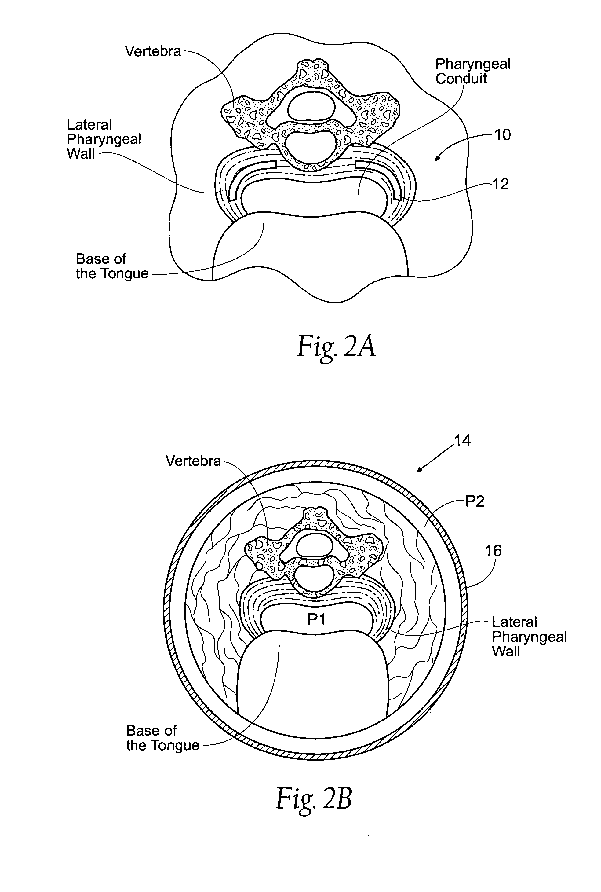 Devices, systems, and methods to fixate tissue within the regions of body, such as the pharyngeal conduit