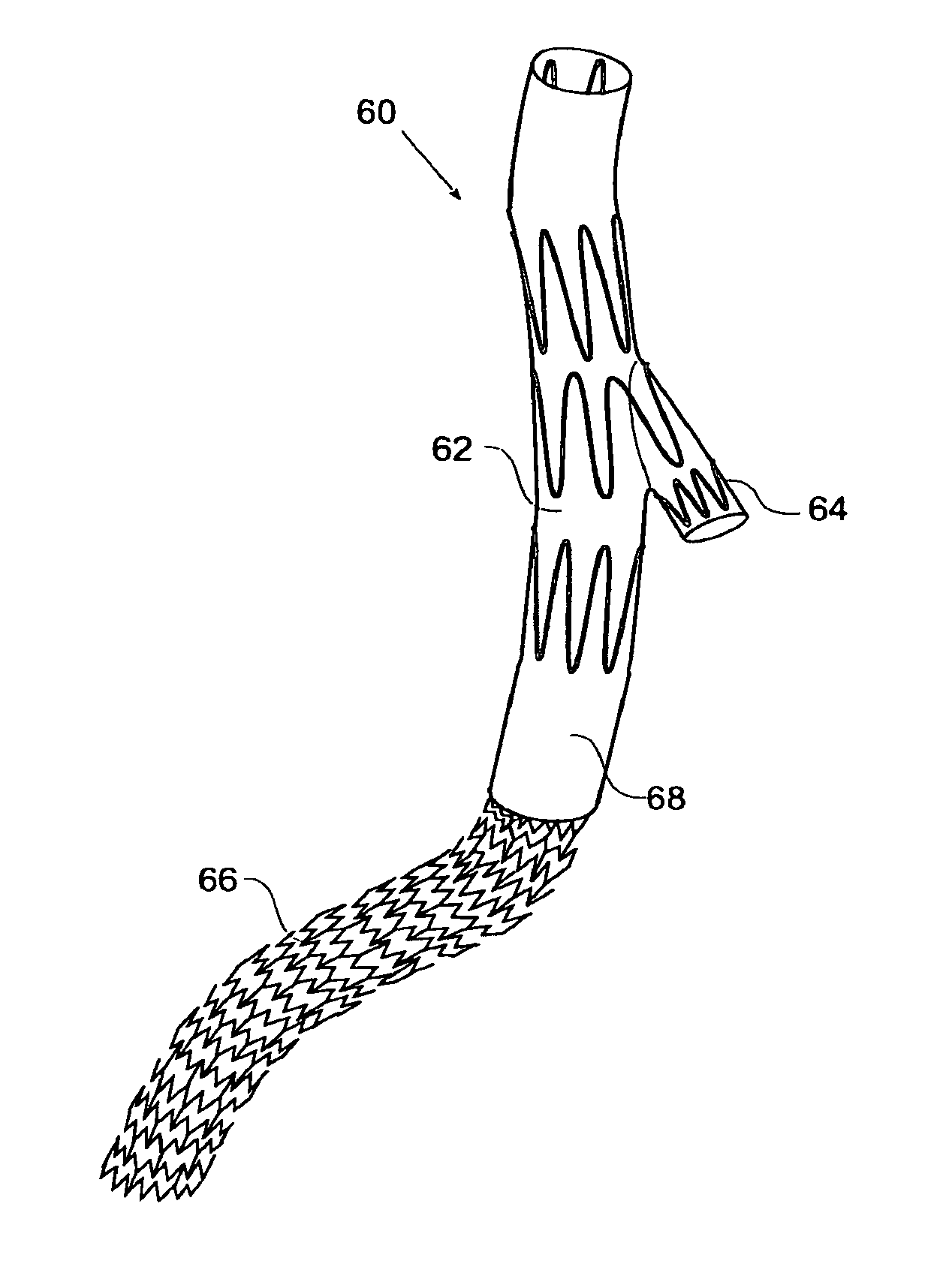 Iliac leg extension stent graft