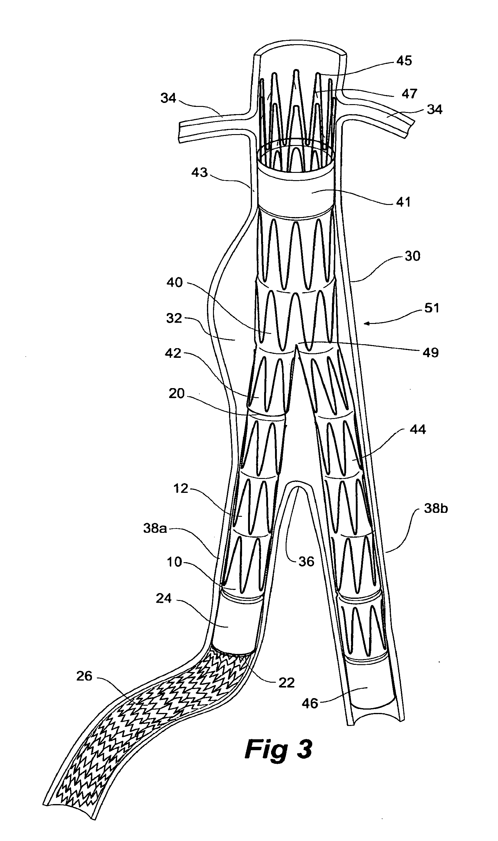 Iliac leg extension stent graft