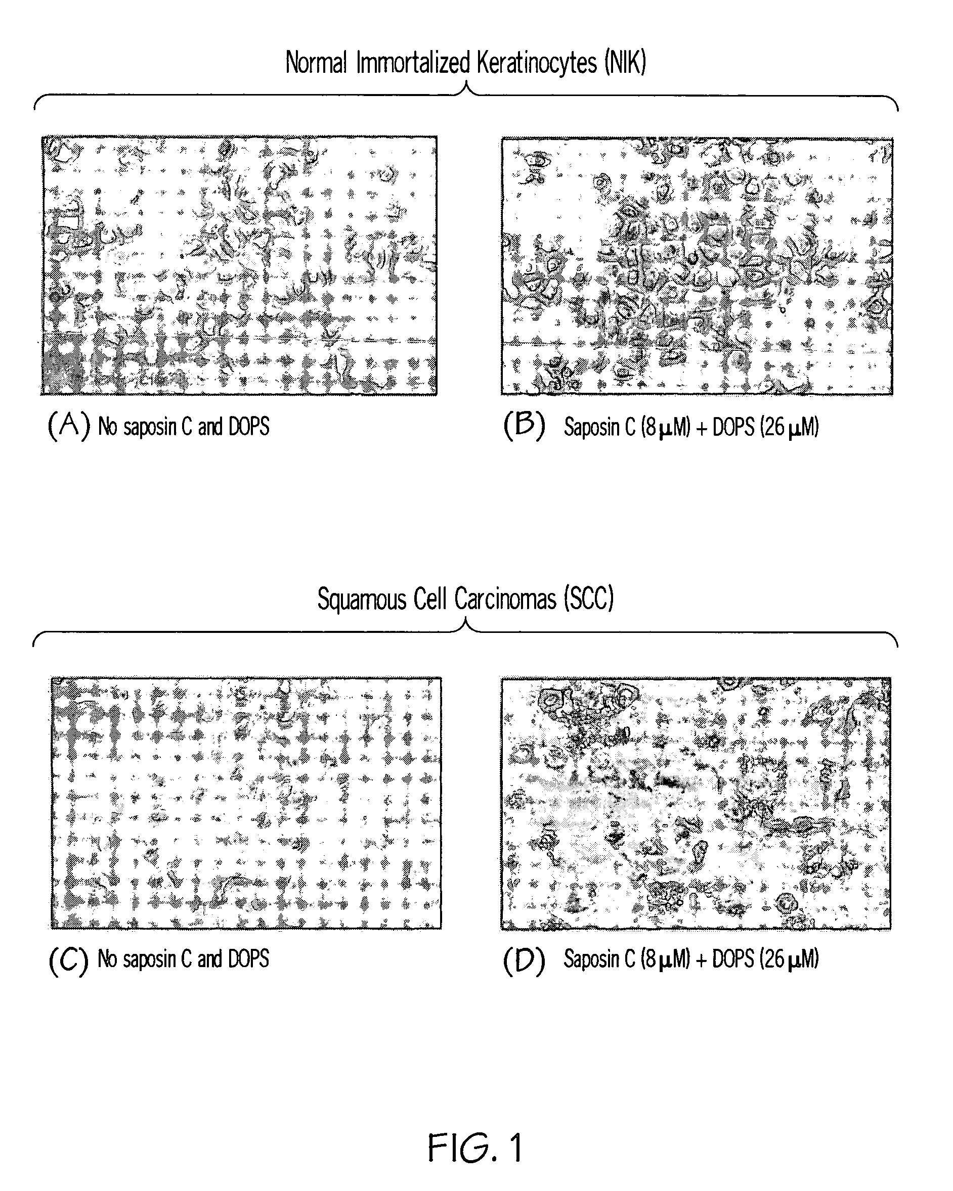 Saposin C-DOPS: a novel anti-tumor agent