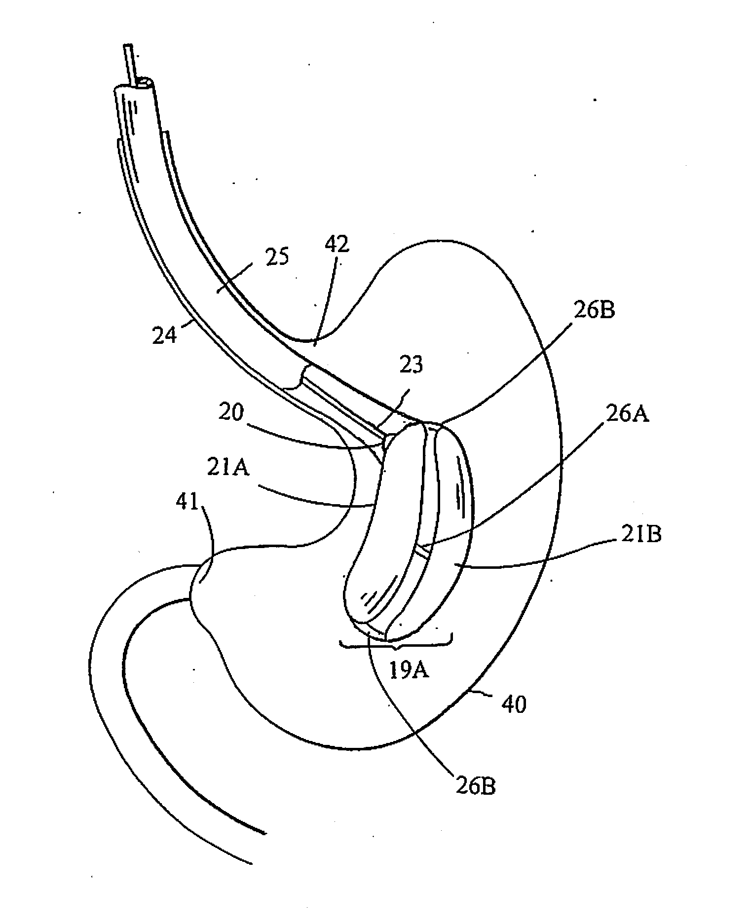 Intragastric space filler