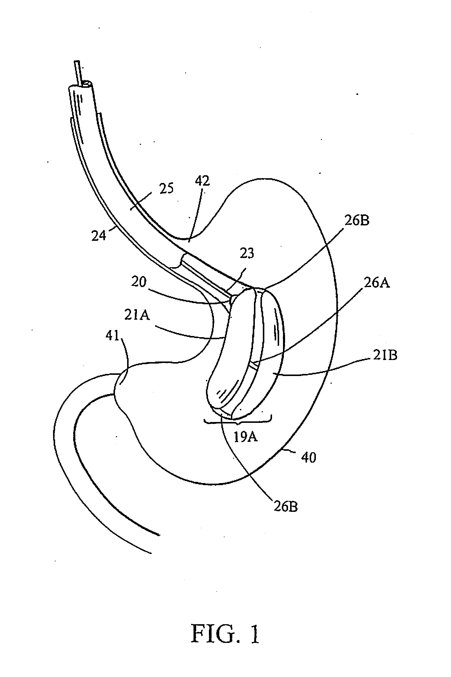 Intragastric space filler