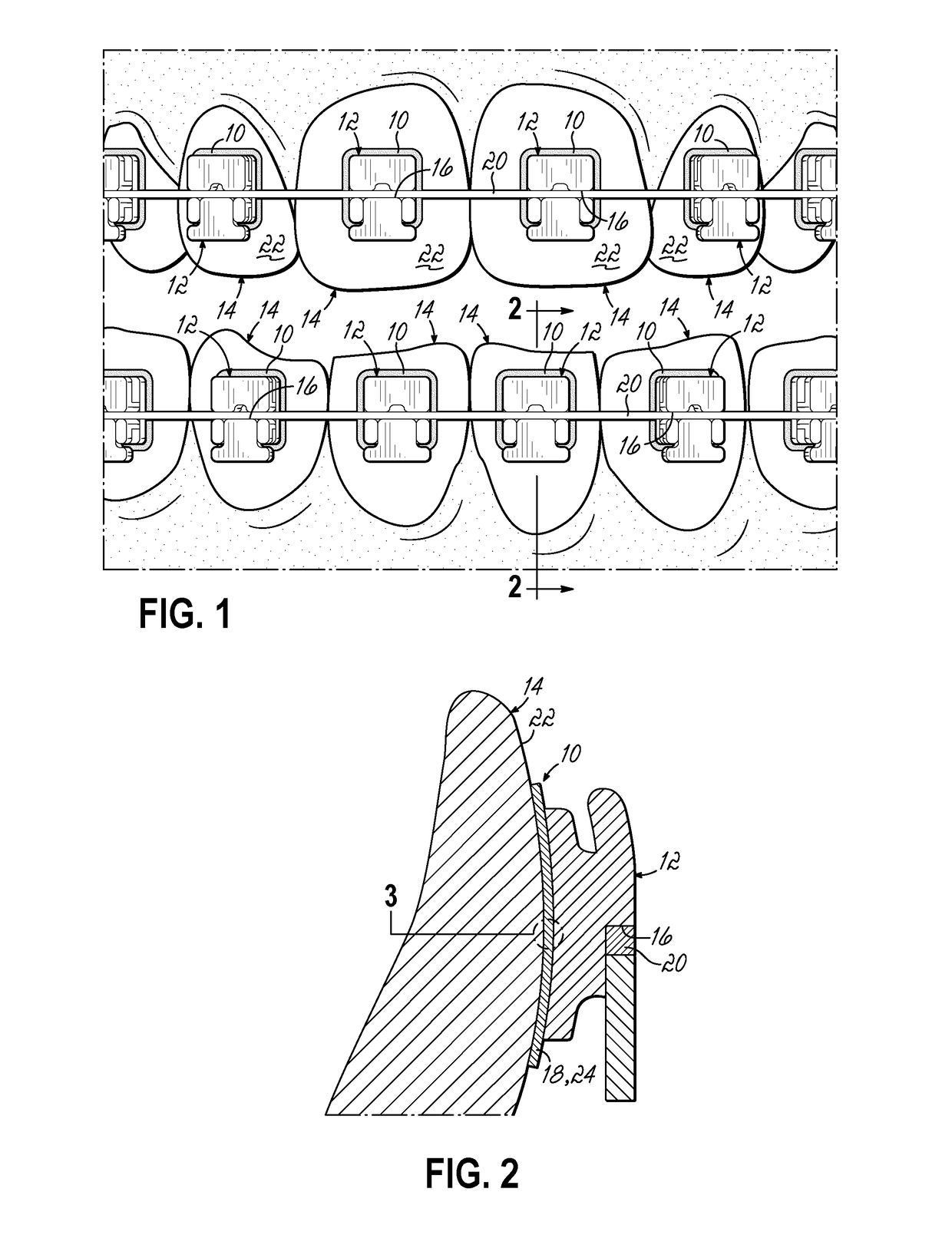 Orthodontic adhesives and methods of using same