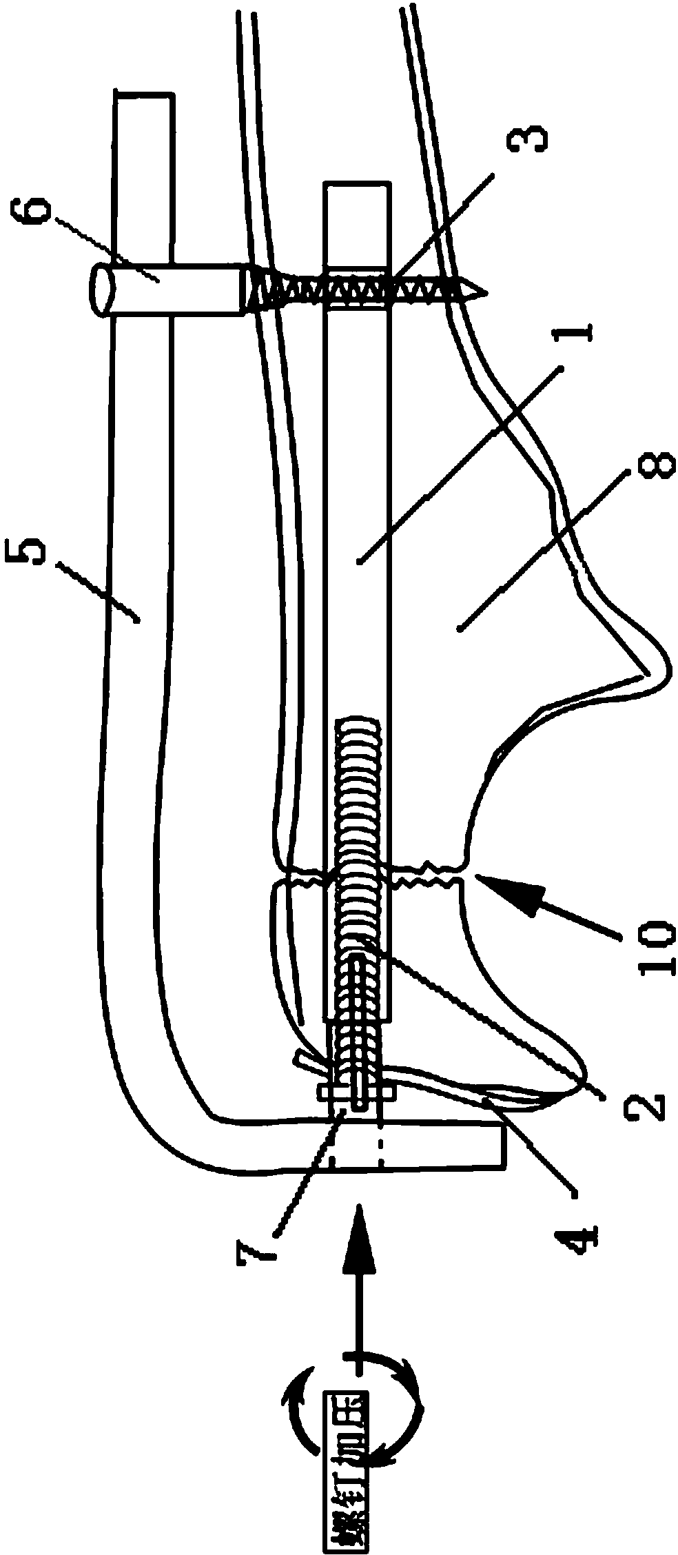 Intramedullary compression nail plate for olecroanon